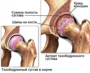 Возрастные особенности гемокоагуляционных изменений при эндопротезировании тазобедренного или коленного сустава Возрастные особенности гемокоагуляционных изменений при эндопротезировании тазобедренного или коленного сустава