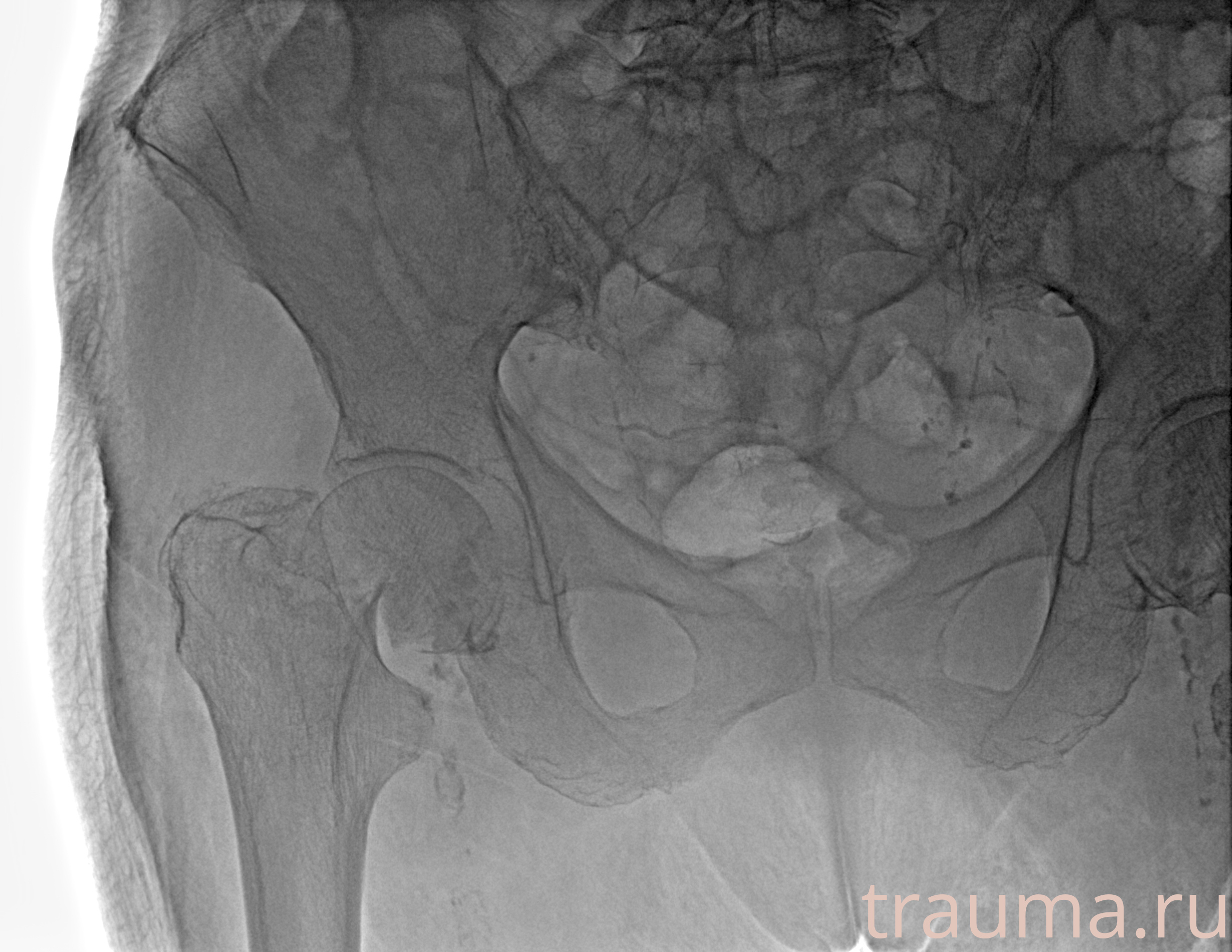 Рентген на дому: по вашему адресу приезжает врач-рентгенолог, травматолог-ортопед с мобильным рентгеновским аппаратом, проводит диагностику травмы или заболевания, делает необходимые рентгенограммы, дает рекомендации по дальнейшему лечению. Получить качественные снимки в домашних условиях возможно благодаря уникальной методике, разработанной МосРентген Центром для института  Склифосовского