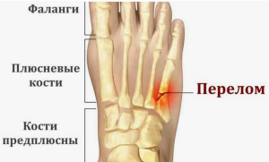 Лечение и реабилитация переломов костей предплюсны и пясти  
