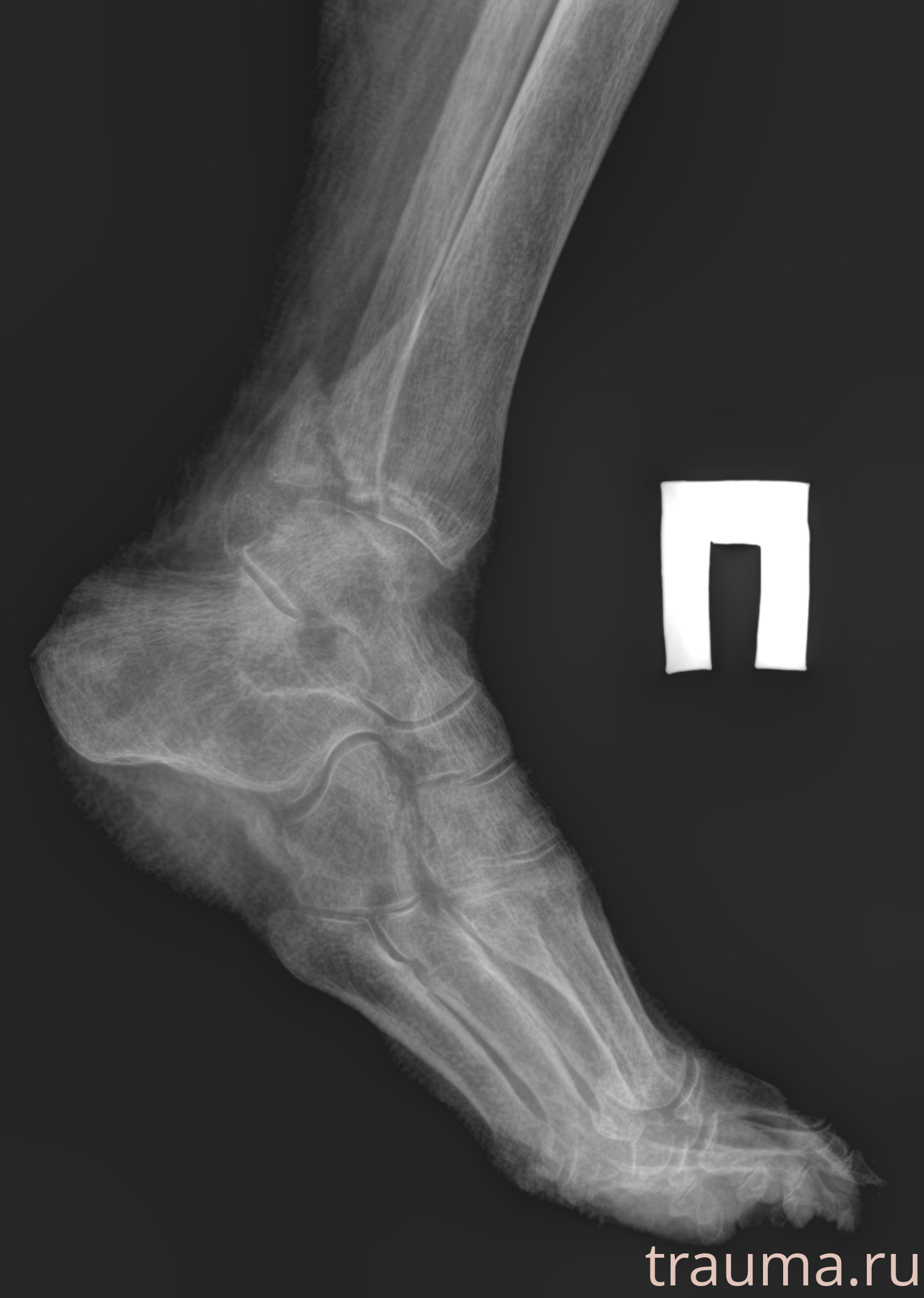 Рентген на дому: по вашему адресу приезжает врач-рентгенолог, травматолог-ортопед с мобильным рентгеновским аппаратом, проводит диагностику травмы или заболевания, делает необходимые рентгенограммы, дает рекомендации по дальнейшему лечению. Получить качественные снимки в домашних условиях возможно благодаря уникальной методике, разработанной МосРентген Центром для института  Склифосовского