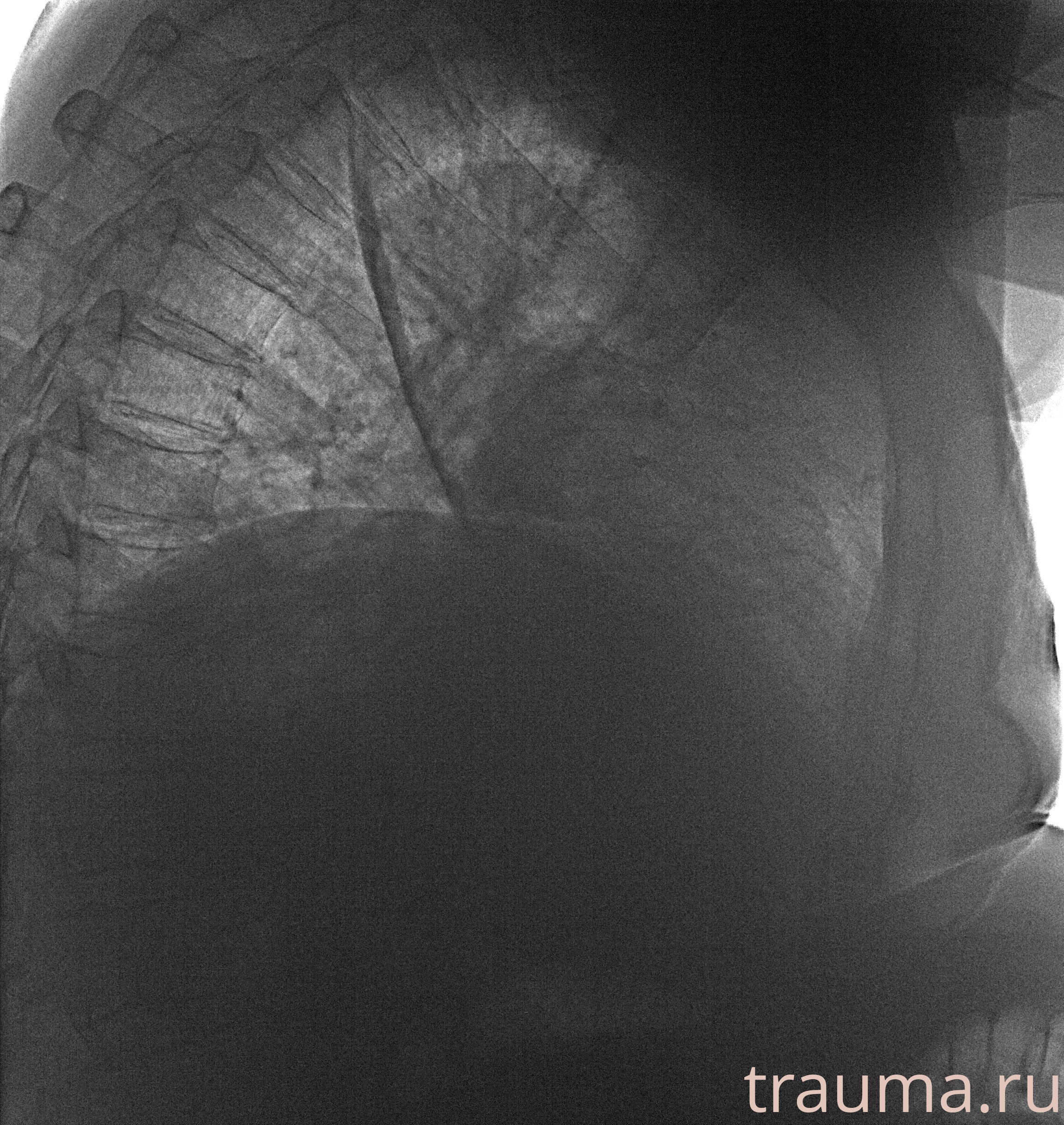 Рентген на дому: по вашему адресу приезжает врач-рентгенолог, травматолог-ортопед с мобильным рентгеновским аппаратом, проводит диагностику травмы или заболевания, делает необходимые рентгенограммы, дает рекомендации по дальнейшему лечению. Получить качественные снимки в домашних условиях возможно благодаря уникальной методике, разработанной МосРентген Центром для института  Склифосовского