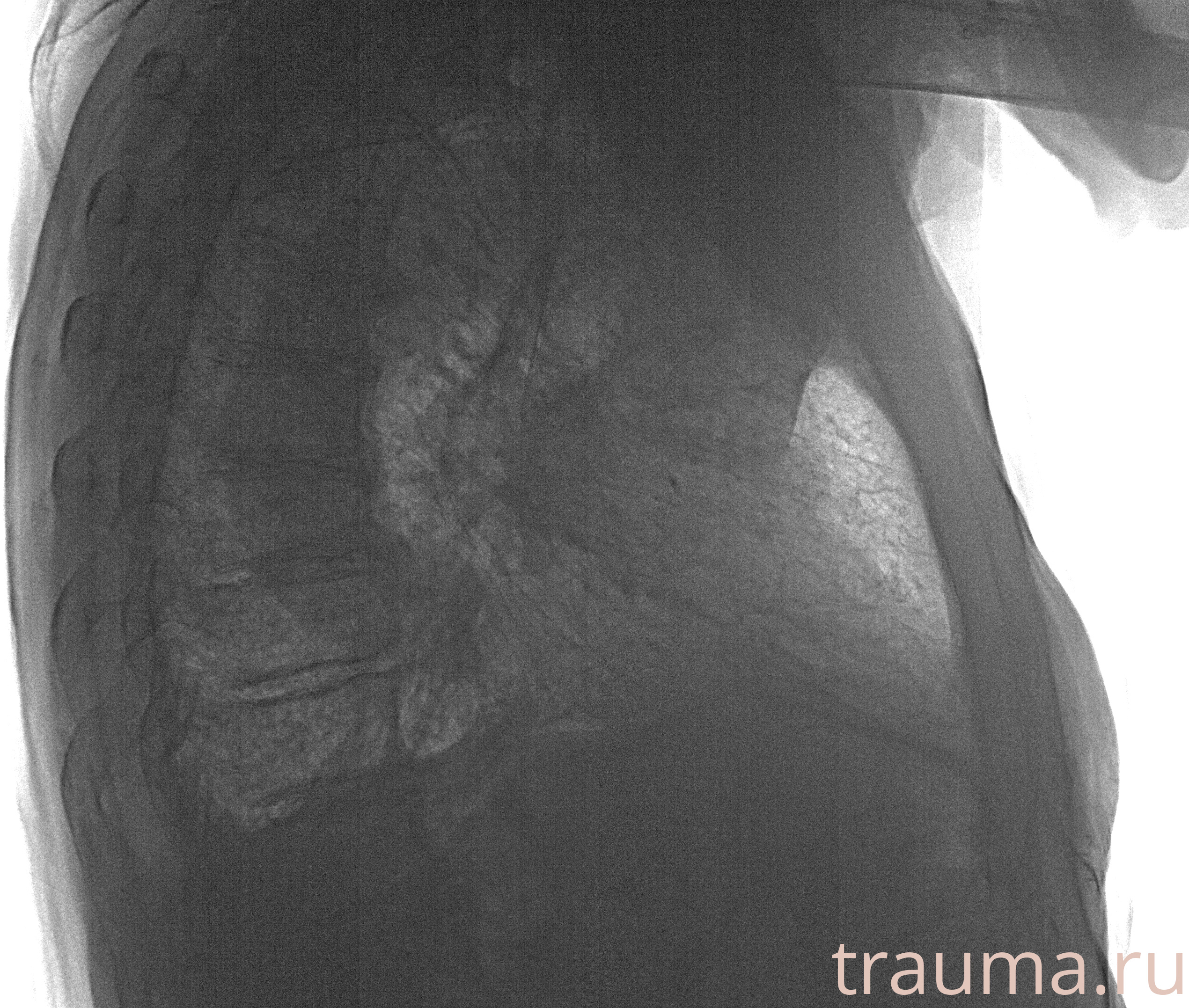 Рентген на дому: по вашему адресу приезжает врач-рентгенолог, травматолог-ортопед с мобильным рентгеновским аппаратом, проводит диагностику травмы или заболевания, делает необходимые рентгенограммы, дает рекомендации по дальнейшему лечению. Получить качественные снимки в домашних условиях возможно благодаря уникальной методике, разработанной МосРентген Центром для института  Склифосовского