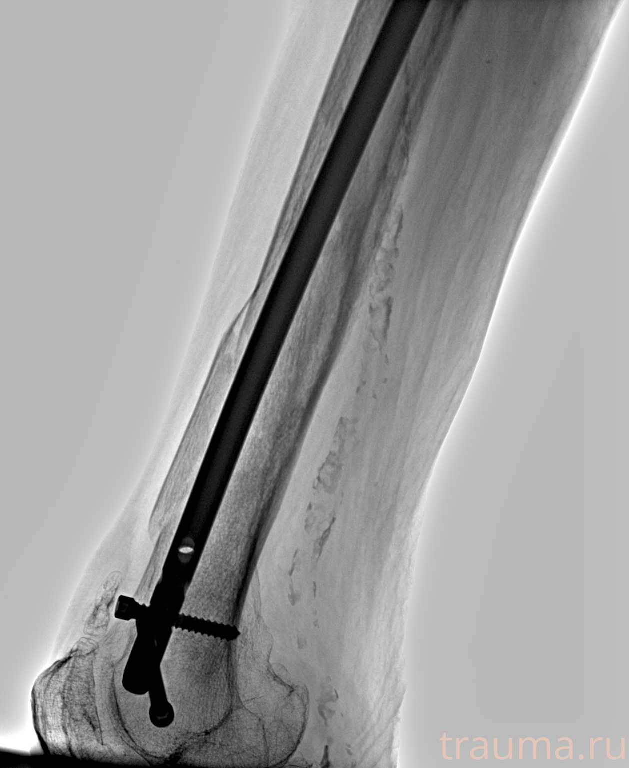 Рентген на дому: по вашему адресу приезжает врач-рентгенолог, травматолог-ортопед с мобильным рентгеновским аппаратом, проводит диагностику травмы или заболевания, делает необходимые рентгенограммы, дает рекомендации по дальнейшему лечению. Получить качественные снимки в домашних условиях возможно благодаря уникальной методике, разработанной МосРентген Центром для института  Склифосовского