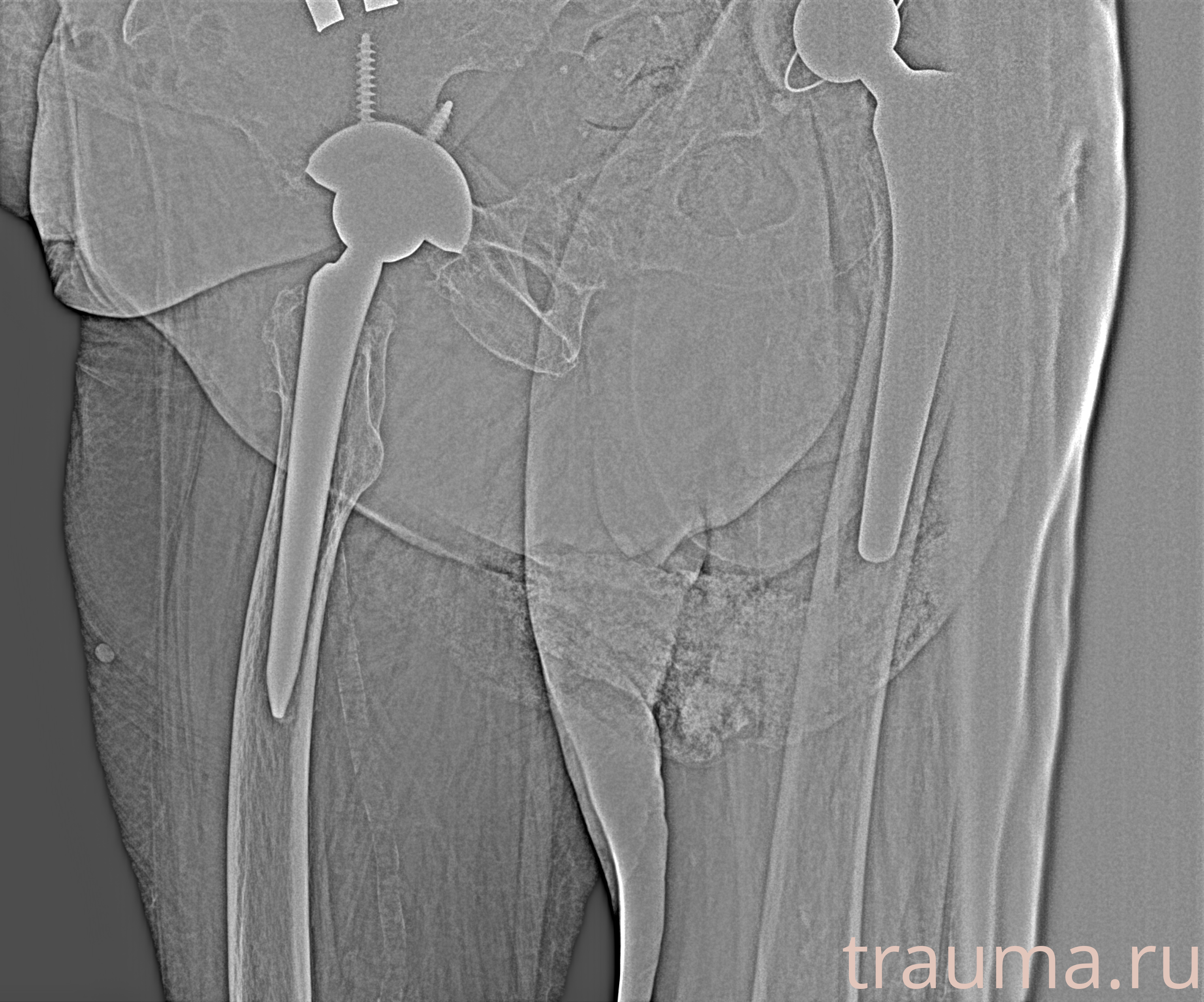 Рентген на дому: по вашему адресу приезжает врач-рентгенолог, травматолог-ортопед с мобильным рентгеновским аппаратом, проводит диагностику травмы или заболевания, делает необходимые рентгенограммы, дает рекомендации по дальнейшему лечению. Получить качественные снимки в домашних условиях возможно благодаря уникальной методике, разработанной МосРентген Центром для института  Склифосовского