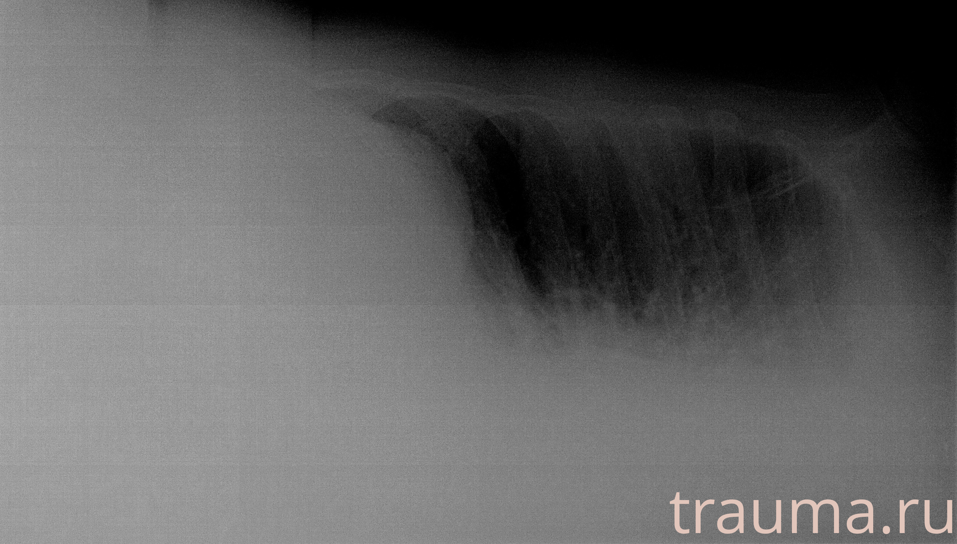 Рентген на дому: по вашему адресу приезжает врач-рентгенолог, травматолог-ортопед с мобильным рентгеновским аппаратом, проводит диагностику травмы или заболевания, делает необходимые рентгенограммы, дает рекомендации по дальнейшему лечению. Получить качественные снимки в домашних условиях возможно благодаря уникальной методике, разработанной МосРентген Центром для института  Склифосовского