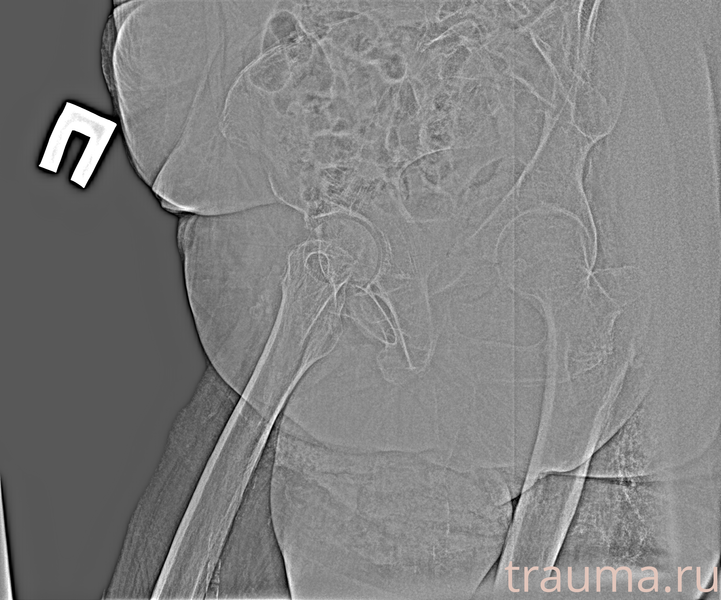 Рентген на дому: по вашему адресу приезжает врач-рентгенолог, травматолог-ортопед с мобильным рентгеновским аппаратом, проводит диагностику травмы или заболевания, делает необходимые рентгенограммы, дает рекомендации по дальнейшему лечению. Получить качественные снимки в домашних условиях возможно благодаря уникальной методике, разработанной МосРентген Центром для института  Склифосовского