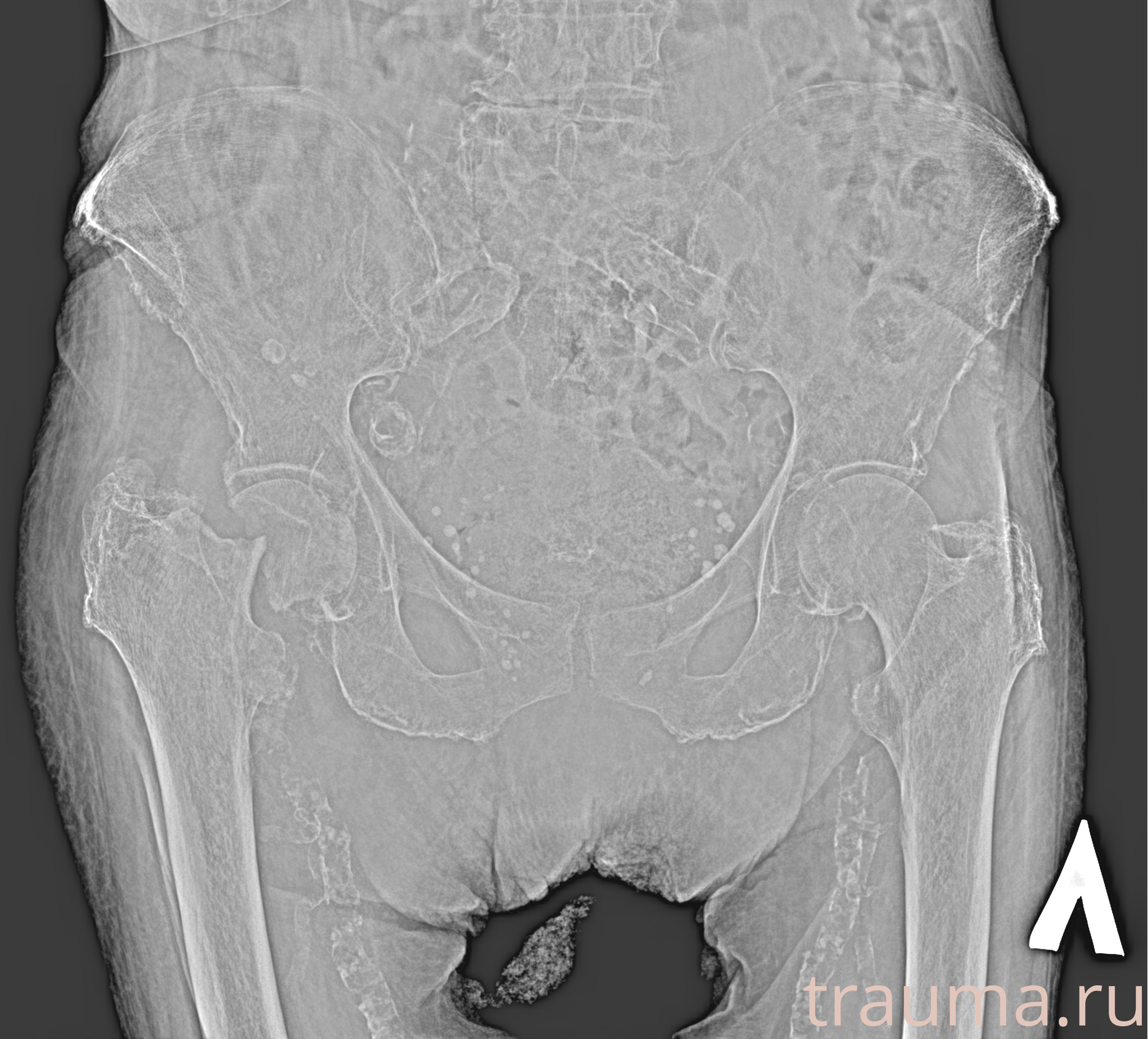 Рентген на дому: по вашему адресу приезжает врач-рентгенолог, травматолог-ортопед с мобильным рентгеновским аппаратом, проводит диагностику травмы или заболевания, делает необходимые рентгенограммы, дает рекомендации по дальнейшему лечению. Получить качественные снимки в домашних условиях возможно благодаря уникальной методике, разработанной МосРентген Центром для института  Склифосовского