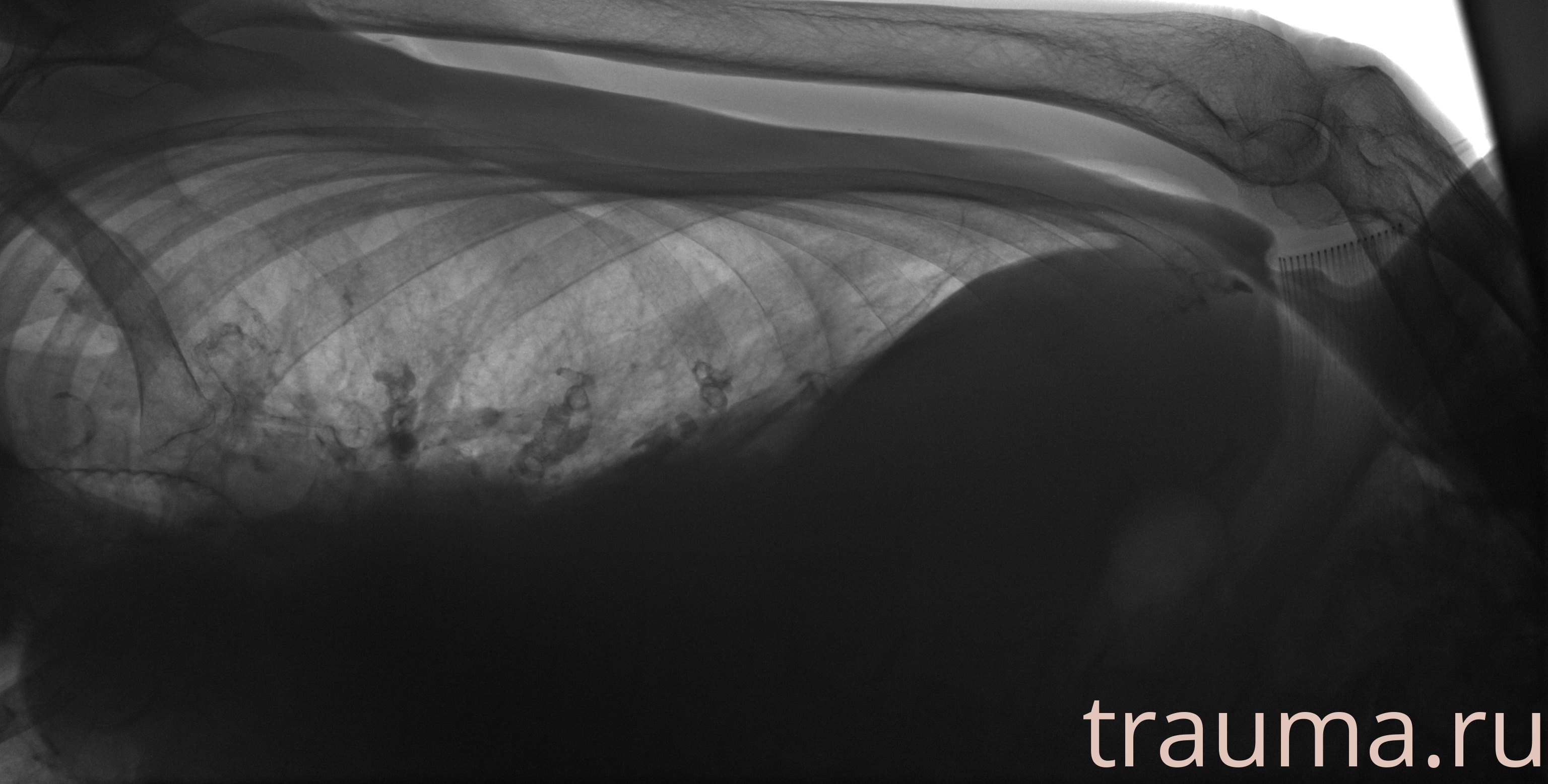 Рентген на дому: по вашему адресу приезжает врач-рентгенолог, травматолог-ортопед с мобильным рентгеновским аппаратом, проводит диагностику травмы или заболевания, делает необходимые рентгенограммы, дает рекомендации по дальнейшему лечению. Получить качественные снимки в домашних условиях возможно благодаря уникальной методике, разработанной МосРентген Центром для института  Склифосовского