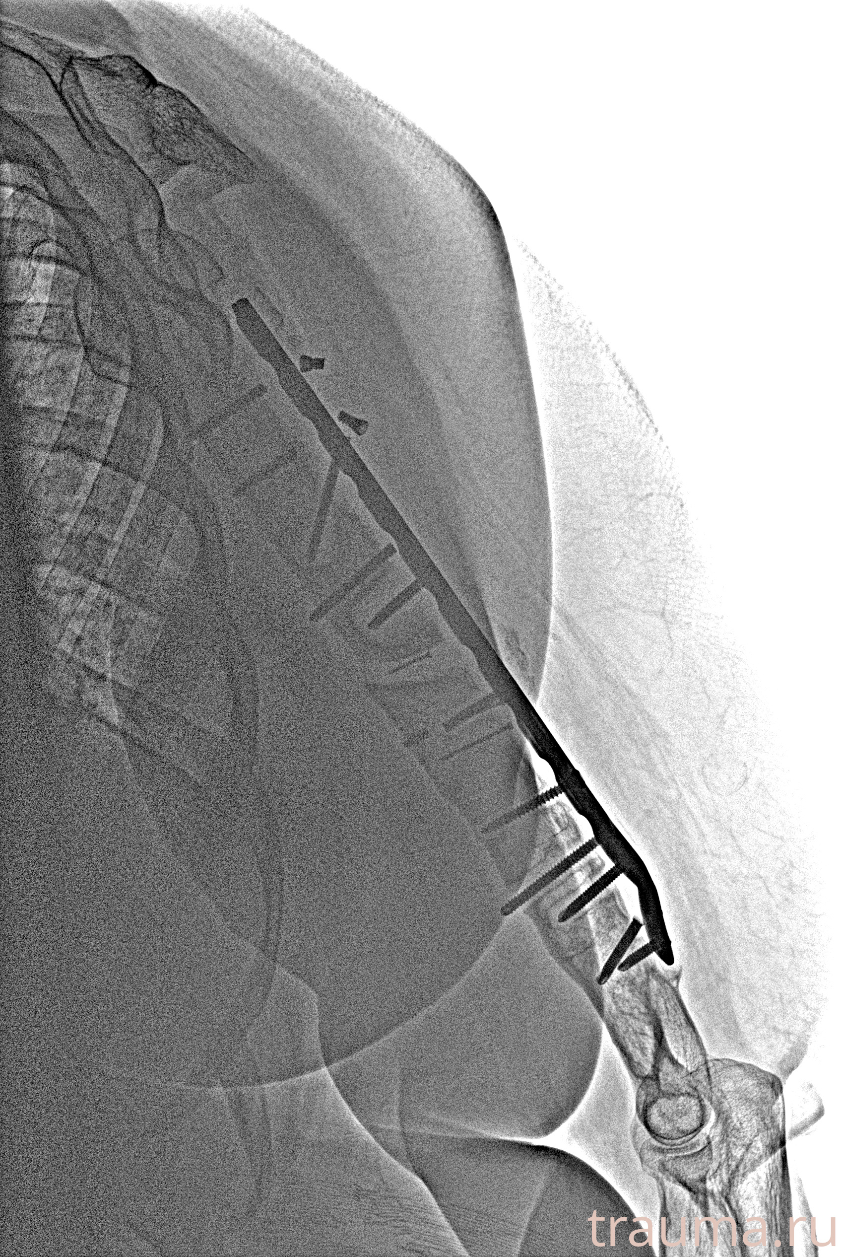 Рентген на дому: по вашему адресу приезжает врач-рентгенолог, травматолог-ортопед с мобильным рентгеновским аппаратом, проводит диагностику травмы или заболевания, делает необходимые рентгенограммы, дает рекомендации по дальнейшему лечению. Получить качественные снимки в домашних условиях возможно благодаря уникальной методике, разработанной МосРентген Центром для института  Склифосовского
