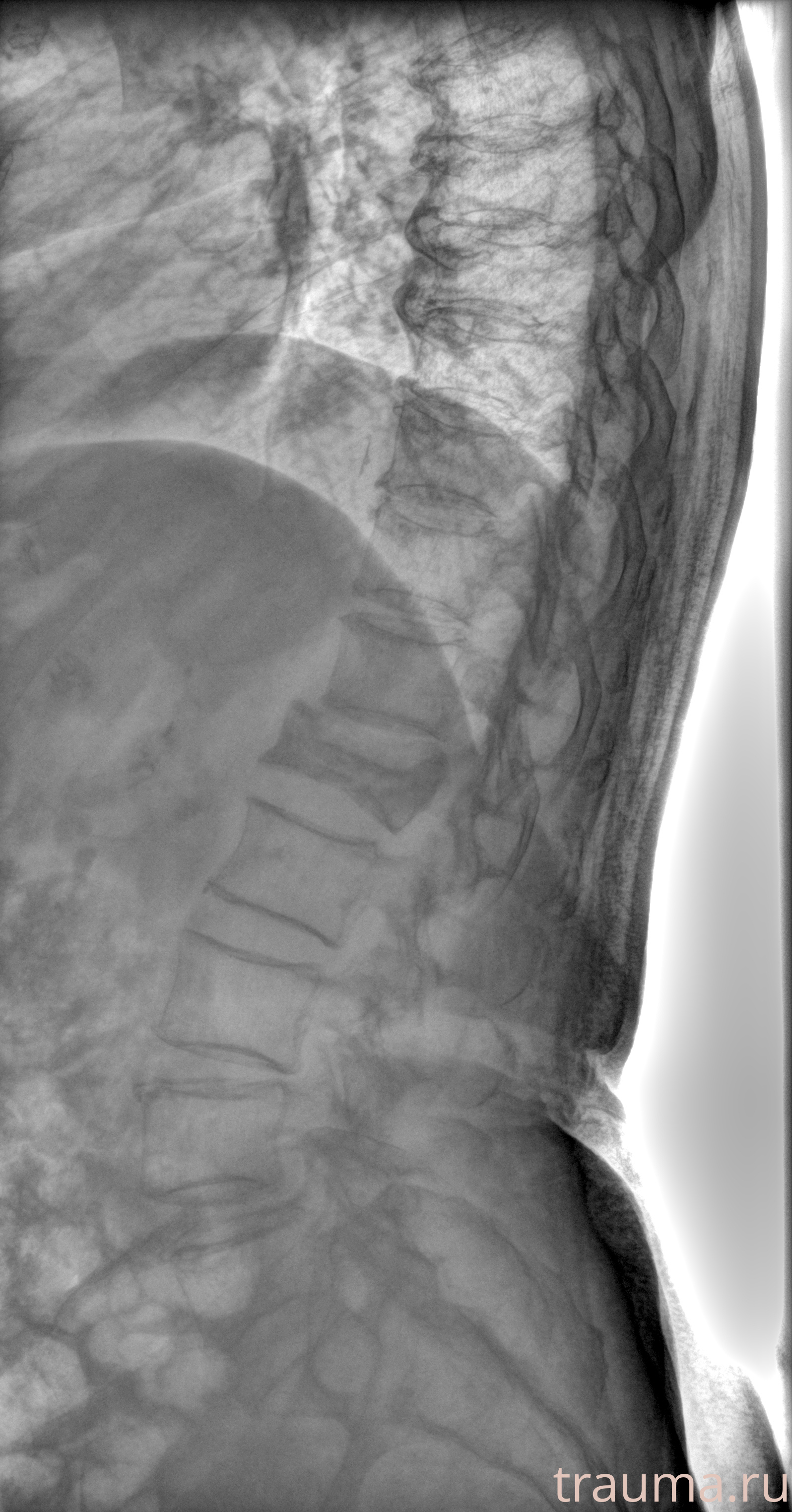 Рентген на дому: по вашему адресу приезжает врач-рентгенолог, травматолог-ортопед с мобильным рентгеновским аппаратом, проводит диагностику травмы или заболевания, делает необходимые рентгенограммы, дает рекомендации по дальнейшему лечению. Получить качественные снимки в домашних условиях возможно благодаря уникальной методике, разработанной МосРентген Центром для института  Склифосовского