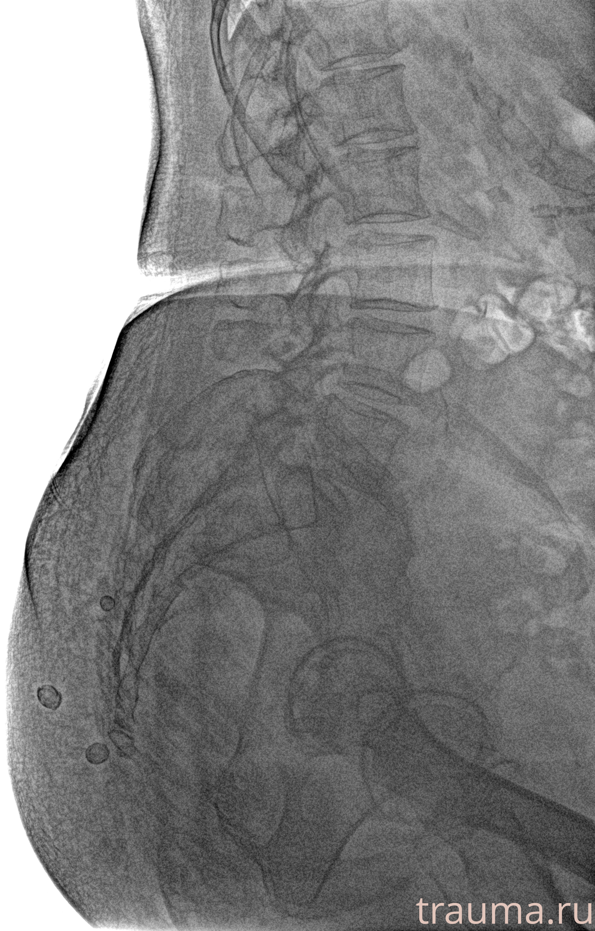 Рентген на дому: по вашему адресу приезжает врач-рентгенолог, травматолог-ортопед с мобильным рентгеновским аппаратом, проводит диагностику травмы или заболевания, делает необходимые рентгенограммы, дает рекомендации по дальнейшему лечению. Получить качественные снимки в домашних условиях возможно благодаря уникальной методике, разработанной МосРентген Центром для института  Склифосовского