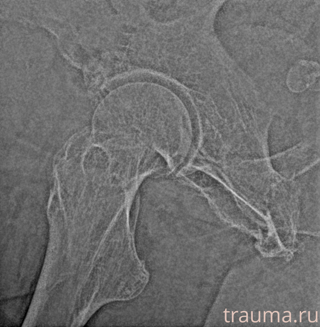 Рентген на дому: по вашему адресу приезжает врач-рентгенолог, травматолог-ортопед с мобильным рентгеновским аппаратом, проводит диагностику травмы или заболевания, делает необходимые рентгенограммы, дает рекомендации по дальнейшему лечению. Получить качественные снимки в домашних условиях возможно благодаря уникальной методике, разработанной МосРентген Центром для института  Склифосовского