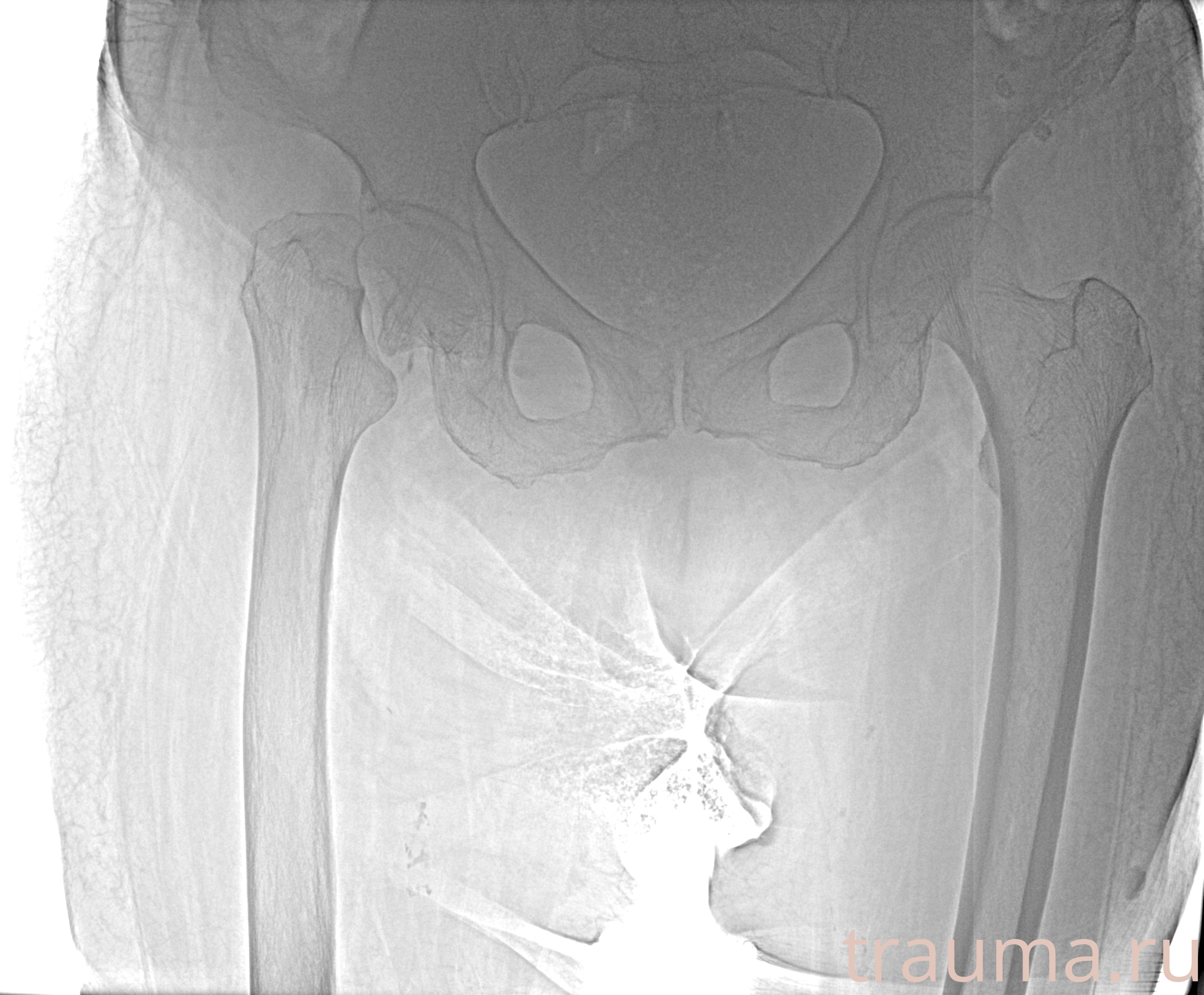 Рентген на дому: по вашему адресу приезжает врач-рентгенолог, травматолог-ортопед с мобильным рентгеновским аппаратом, проводит диагностику травмы или заболевания, делает необходимые рентгенограммы, дает рекомендации по дальнейшему лечению. Получить качественные снимки в домашних условиях возможно благодаря уникальной методике, разработанной МосРентген Центром для института  Склифосовского