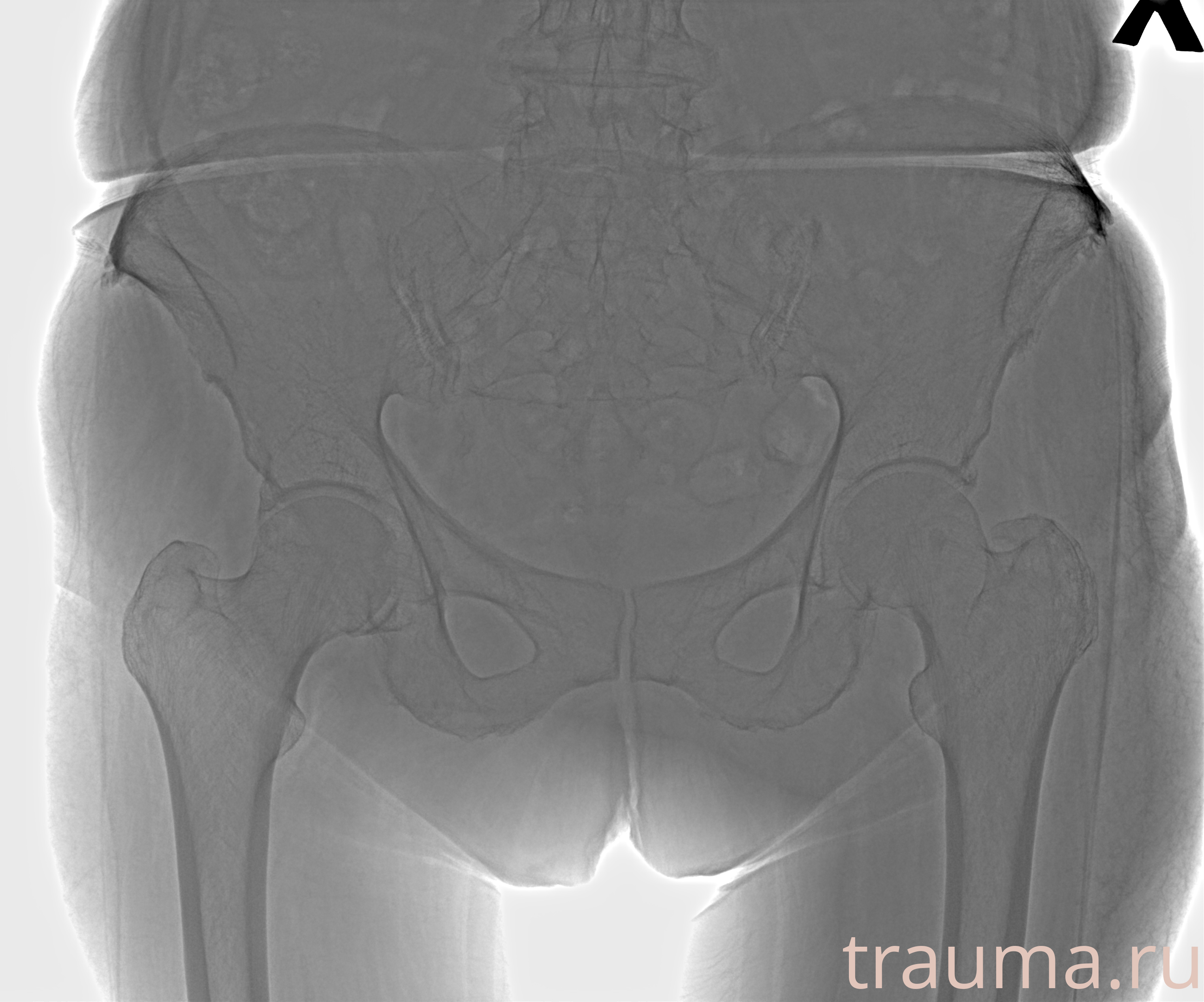 Рентген на дому: по вашему адресу приезжает врач-рентгенолог, травматолог-ортопед с мобильным рентгеновским аппаратом, проводит диагностику травмы или заболевания, делает необходимые рентгенограммы, дает рекомендации по дальнейшему лечению. Получить качественные снимки в домашних условиях возможно благодаря уникальной методике, разработанной МосРентген Центром для института  Склифосовского