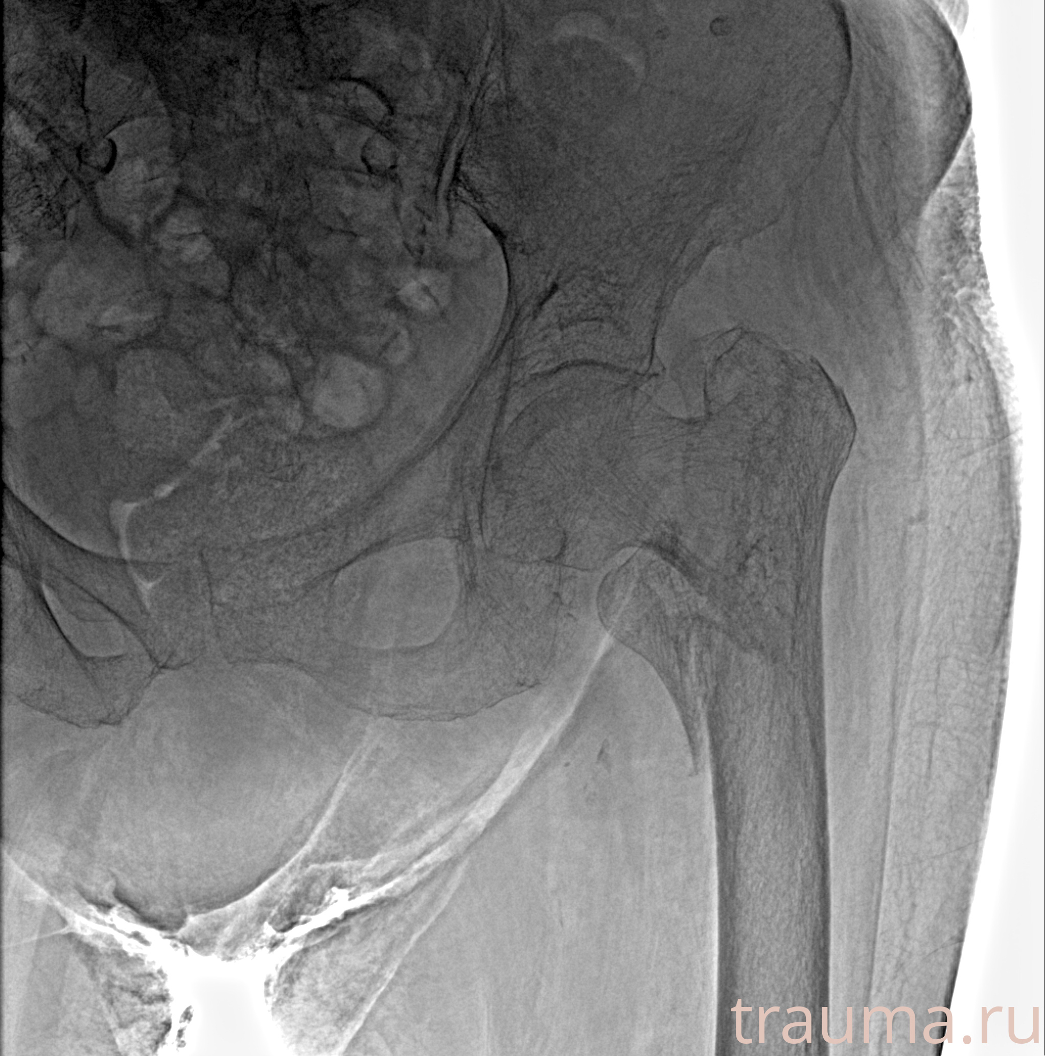 Рентген на дому: по вашему адресу приезжает врач-рентгенолог, травматолог-ортопед с мобильным рентгеновским аппаратом, проводит диагностику травмы или заболевания, делает необходимые рентгенограммы, дает рекомендации по дальнейшему лечению. Получить качественные снимки в домашних условиях возможно благодаря уникальной методике, разработанной МосРентген Центром для института  Склифосовского