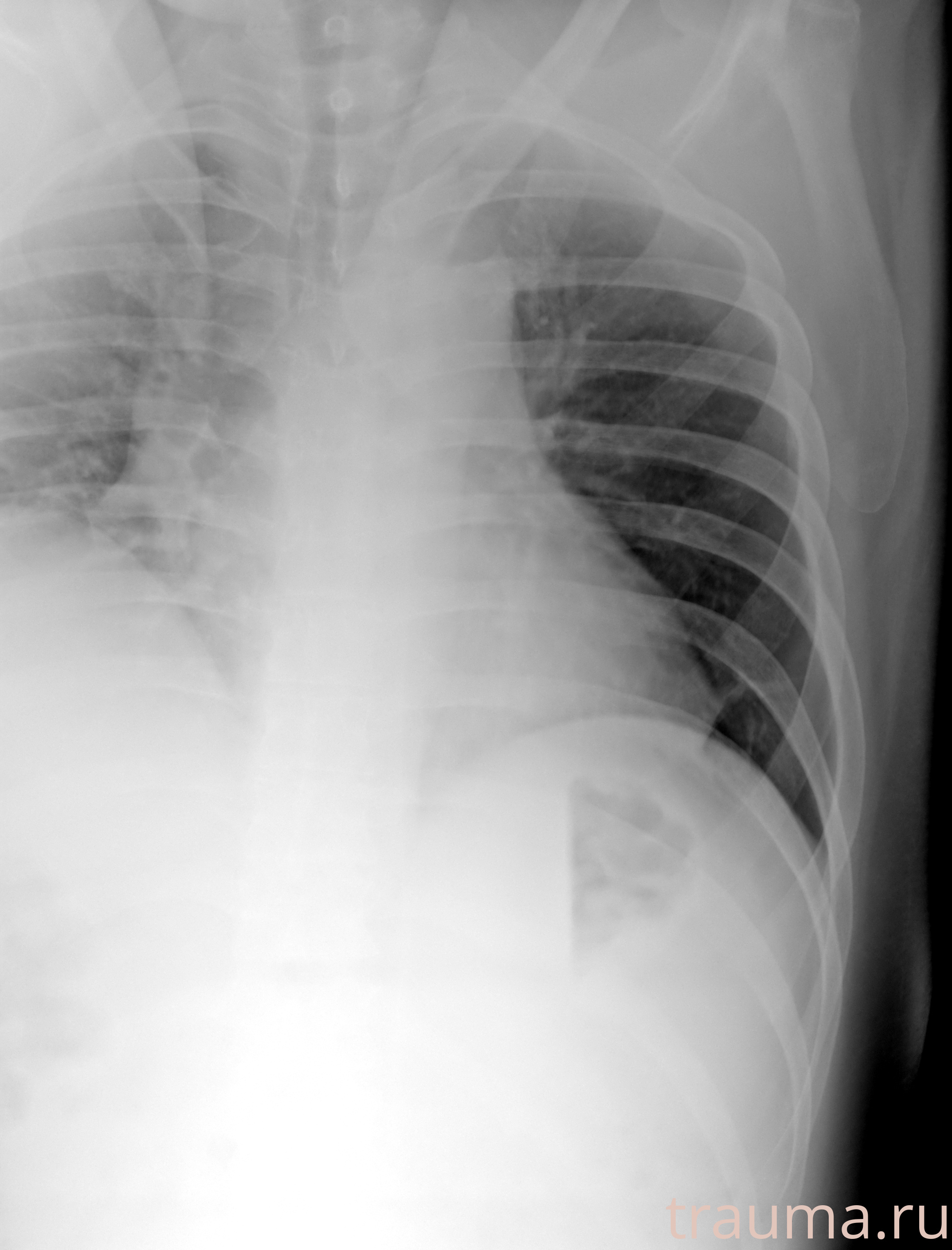 Рентген на дому: по вашему адресу приезжает врач-рентгенолог, травматолог-ортопед с мобильным рентгеновским аппаратом, проводит диагностику травмы или заболевания, делает необходимые рентгенограммы, дает рекомендации по дальнейшему лечению. Получить качественные снимки в домашних условиях возможно благодаря уникальной методике, разработанной МосРентген Центром для института  Склифосовского