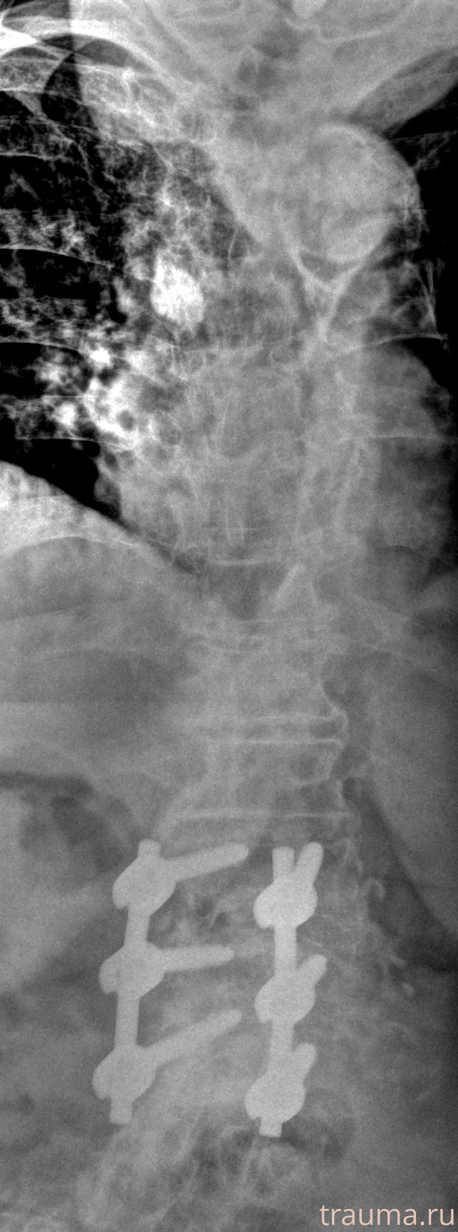 Рентген на дому: по вашему адресу приезжает врач-рентгенолог, травматолог-ортопед с мобильным рентгеновским аппаратом, проводит диагностику травмы или заболевания, делает необходимые рентгенограммы, дает рекомендации по дальнейшему лечению. Получить качественные снимки в домашних условиях возможно благодаря уникальной методике, разработанной МосРентген Центром для института  Склифосовского