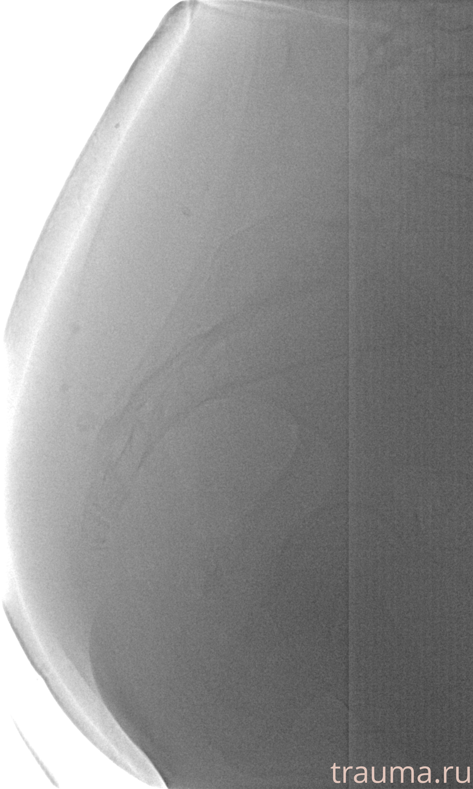 Рентген на дому: по вашему адресу приезжает врач-рентгенолог, травматолог-ортопед с мобильным рентгеновским аппаратом, проводит диагностику травмы или заболевания, делает необходимые рентгенограммы, дает рекомендации по дальнейшему лечению. Получить качественные снимки в домашних условиях возможно благодаря уникальной методике, разработанной МосРентген Центром для института  Склифосовского