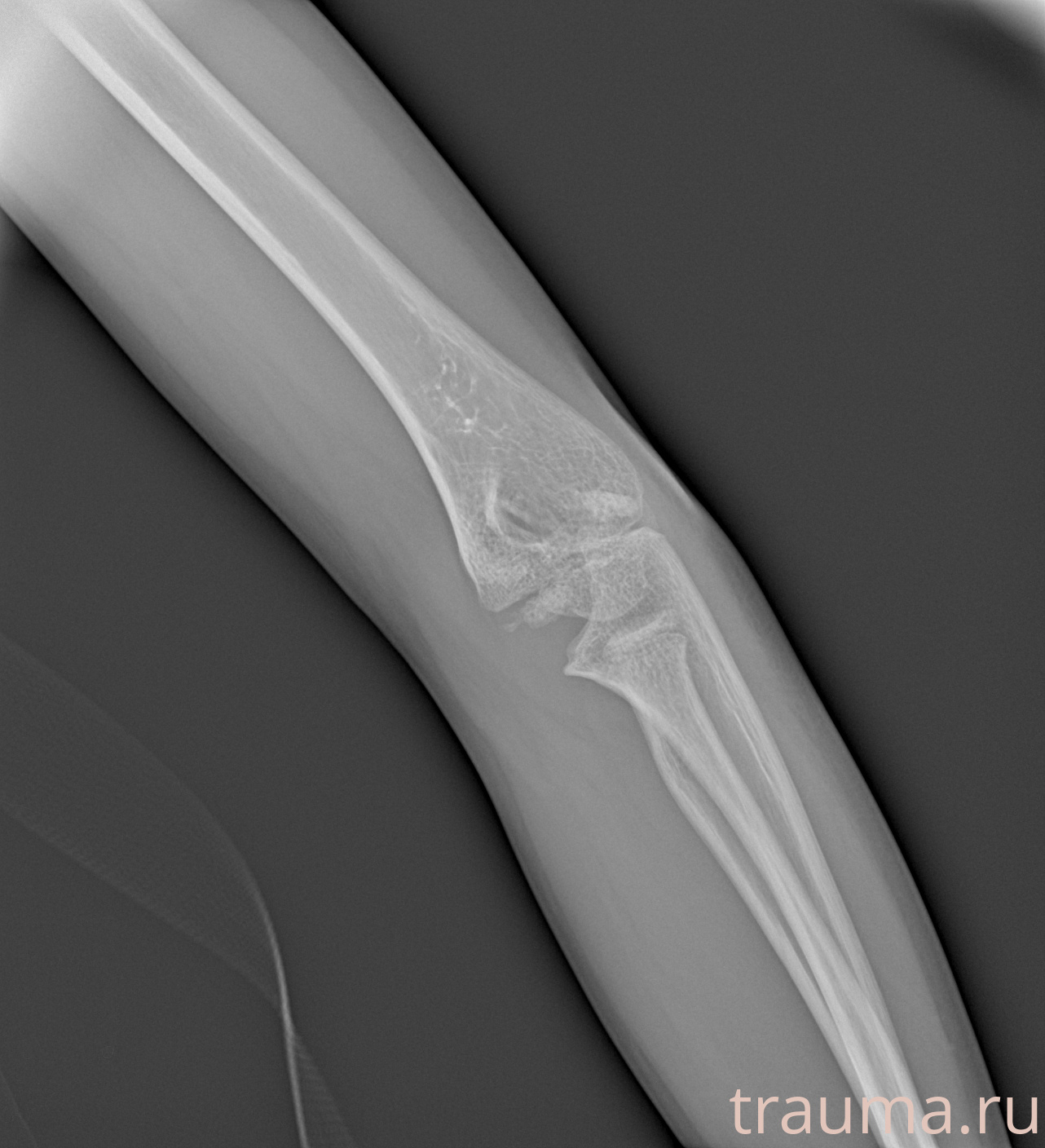 Рентген на дому: по вашему адресу приезжает врач-рентгенолог, травматолог-ортопед с мобильным рентгеновским аппаратом, проводит диагностику травмы или заболевания, делает необходимые рентгенограммы, дает рекомендации по дальнейшему лечению. Получить качественные снимки в домашних условиях возможно благодаря уникальной методике, разработанной МосРентген Центром для института  Склифосовского