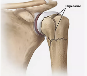 Оценка результатов использования нитевых джойстиков для репозиции отломков и костнопластических аллогенных материалов при возмещении дефектов костной ткани у пациентов с переломами проксимального отдела плечевой кости 