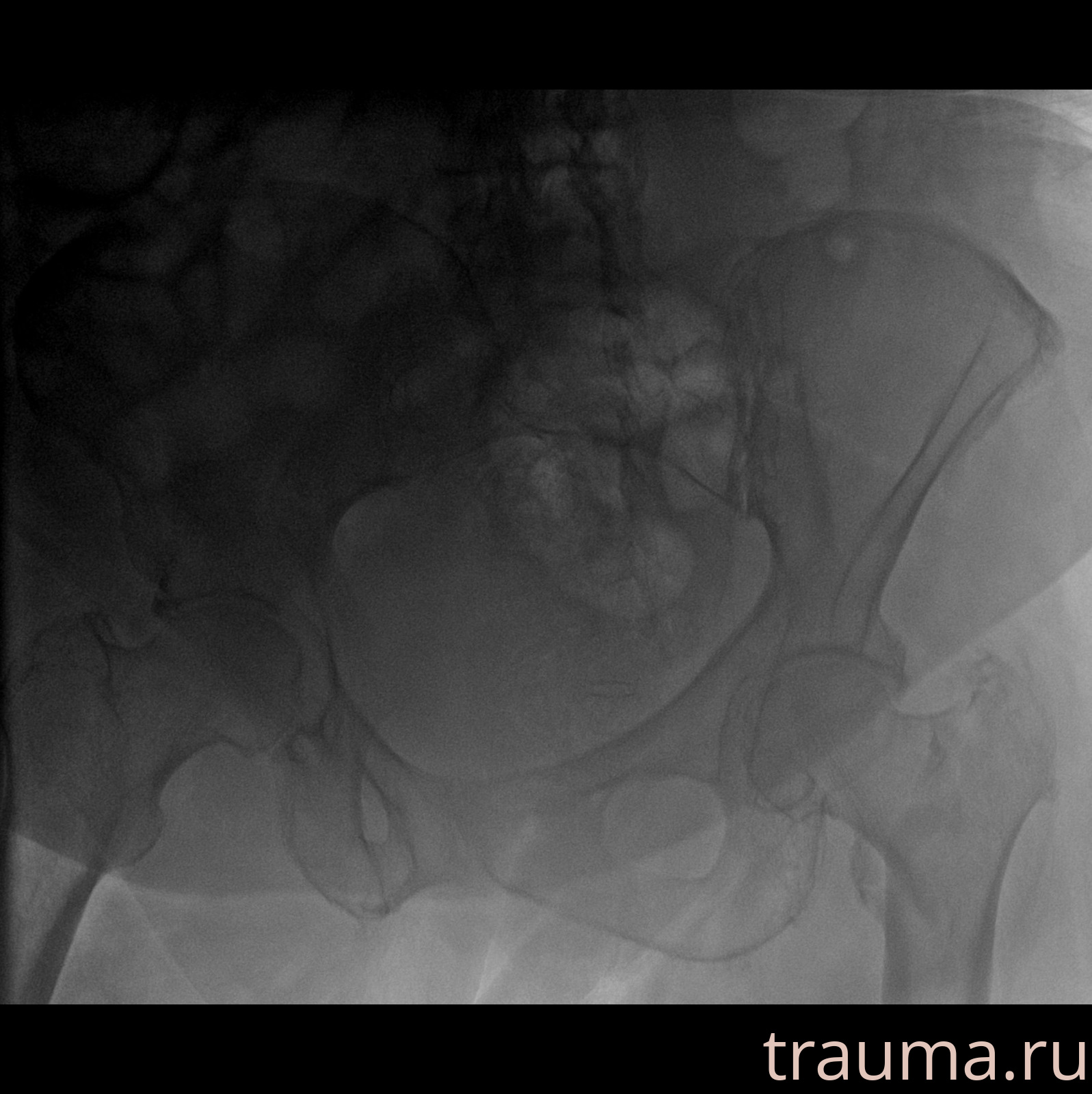 Рентген на дому: по вашему адресу приезжает врач-рентгенолог, травматолог-ортопед с мобильным рентгеновским аппаратом, проводит диагностику травмы или заболевания, делает необходимые рентгенограммы, дает рекомендации по дальнейшему лечению. Получить качественные снимки в домашних условиях возможно благодаря уникальной методике, разработанной МосРентген Центром для института  Склифосовского