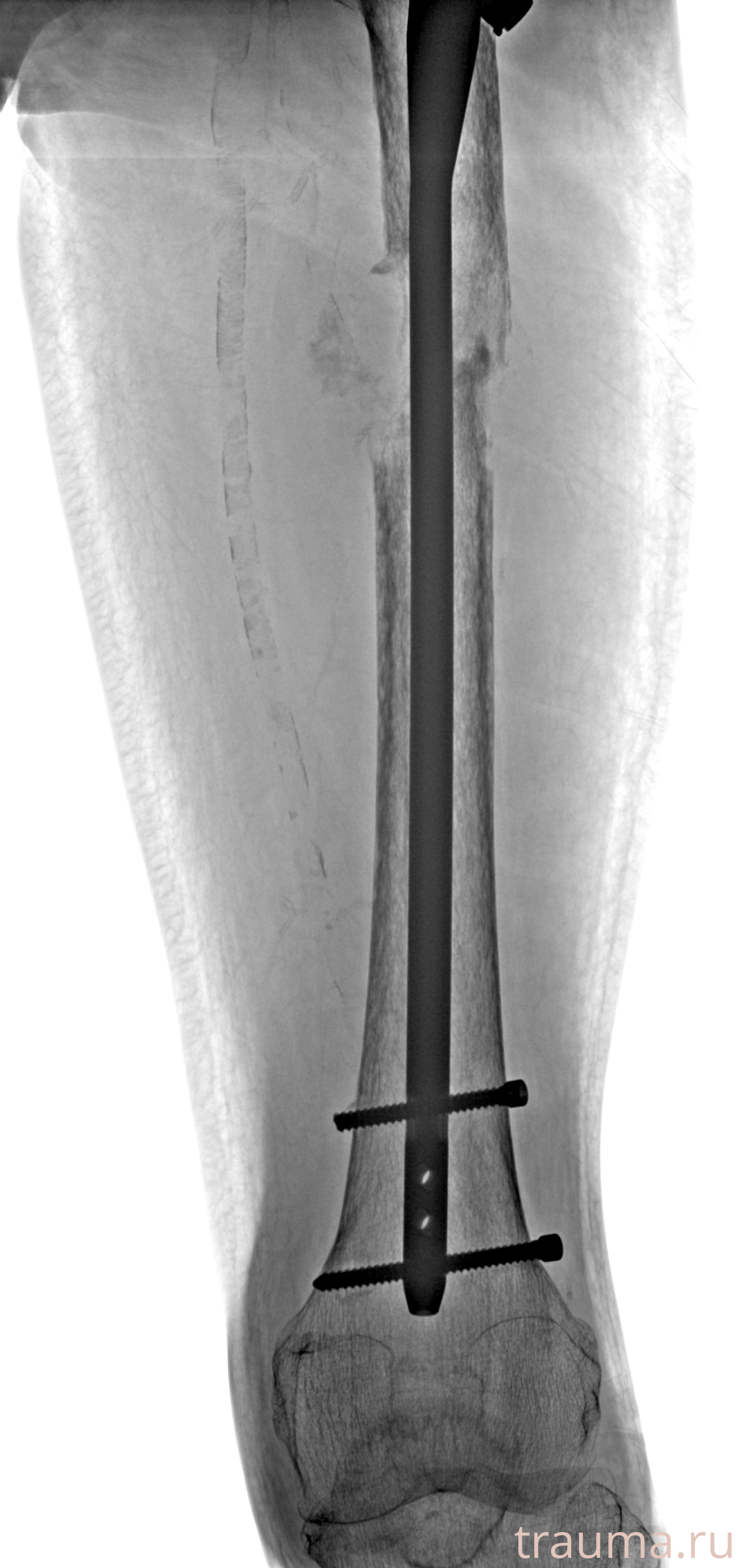 Рентген на дому: по вашему адресу приезжает врач-рентгенолог, травматолог-ортопед с мобильным рентгеновским аппаратом, проводит диагностику травмы или заболевания, делает необходимые рентгенограммы, дает рекомендации по дальнейшему лечению. Получить качественные снимки в домашних условиях возможно благодаря уникальной методике, разработанной МосРентген Центром для института  Склифосовского