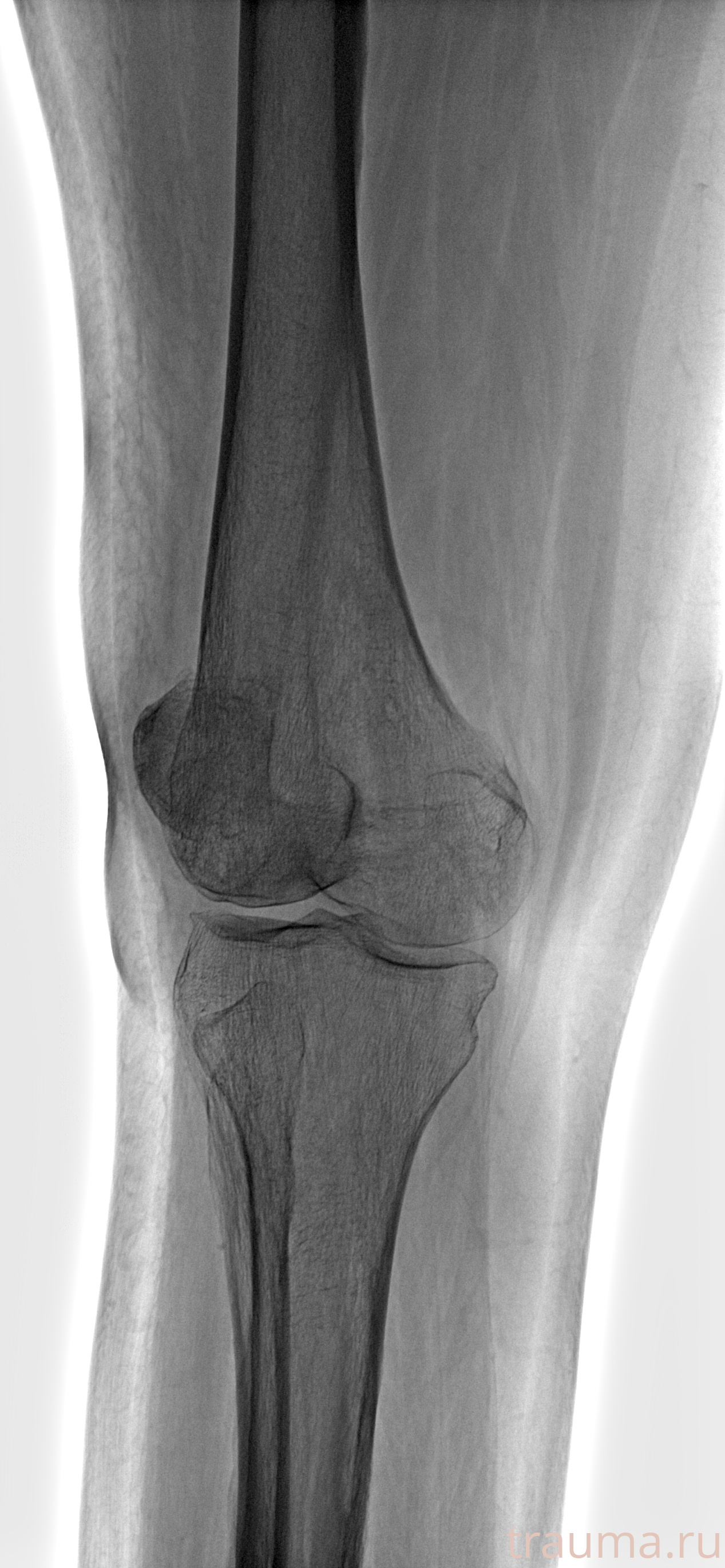 Рентген на дому: по вашему адресу приезжает врач-рентгенолог, травматолог-ортопед с мобильным рентгеновским аппаратом, проводит диагностику травмы или заболевания, делает необходимые рентгенограммы, дает рекомендации по дальнейшему лечению. Получить качественные снимки в домашних условиях возможно благодаря уникальной методике, разработанной МосРентген Центром для института  Склифосовского