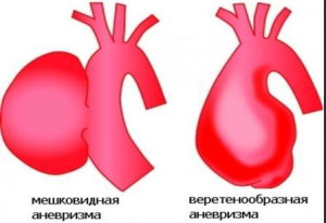 Курс медицинской рентгенологии.Рентгенологическое исследование органов кровообращения(сердца и больших сосудов).Часть 2. Глава 8.6 Курс медицинской рентгенологии.Рентгенологическое исследование органов кровообращения(сердца и больших сосудов).Часть 2. Глава 8.6