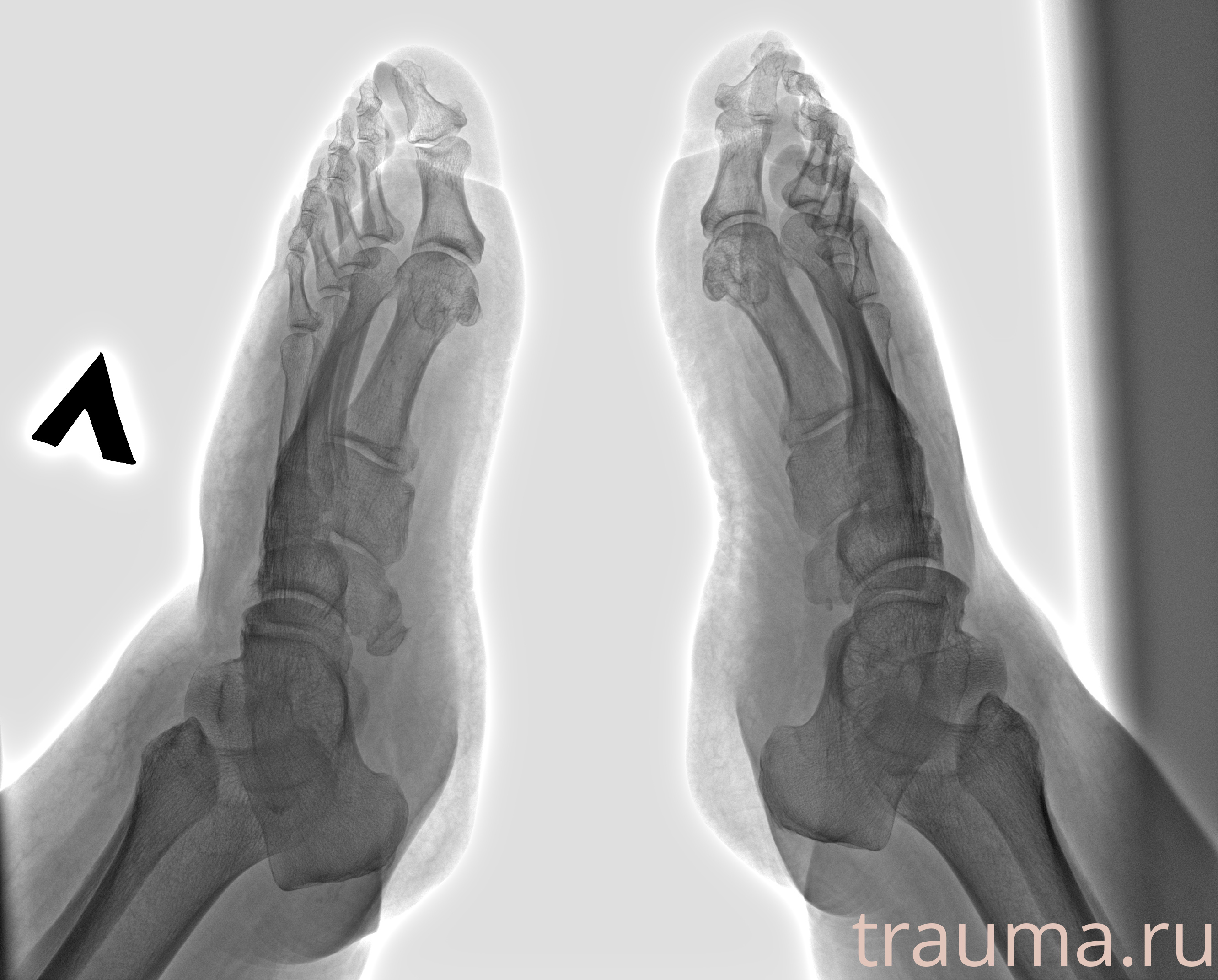 Рентген на дому: по вашему адресу приезжает врач-рентгенолог, травматолог-ортопед с мобильным рентгеновским аппаратом, проводит диагностику травмы или заболевания, делает необходимые рентгенограммы, дает рекомендации по дальнейшему лечению. Получить качественные снимки в домашних условиях возможно благодаря уникальной методике, разработанной МосРентген Центром для института  Склифосовского