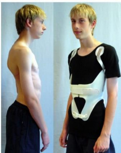 Возможности оперативного лечения кифозов III типа методом «Pedicle subtraction osteotomy» Возможности оперативного лечения кифозов III типа методом «Pedicle subtraction osteotomy»