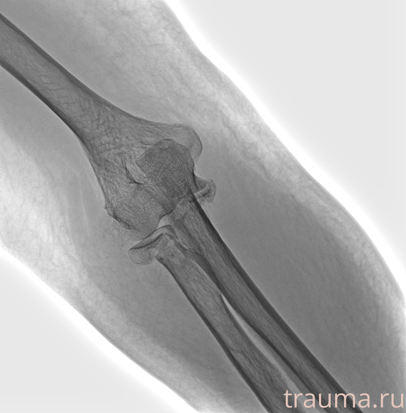 Рентген на дому: по вашему адресу приезжает врач-рентгенолог, травматолог-ортопед с мобильным рентгеновским аппаратом, проводит диагностику травмы или заболевания, делает необходимые рентгенограммы, дает рекомендации по дальнейшему лечению. Получить качественные снимки в домашних условиях возможно благодаря уникальной методике, разработанной МосРентген Центром для института  Склифосовского