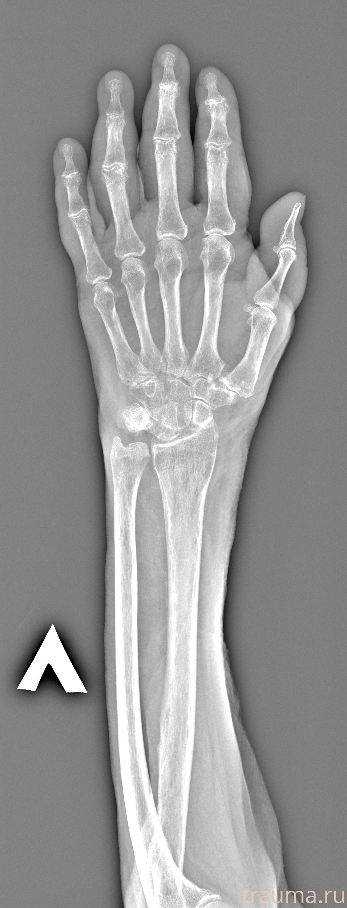 Рентген на дому: по вашему адресу приезжает врач-рентгенолог, травматолог-ортопед с мобильным рентгеновским аппаратом, проводит диагностику травмы или заболевания, делает необходимые рентгенограммы, дает рекомендации по дальнейшему лечению. Получить качественные снимки в домашних условиях возможно благодаря уникальной методике, разработанной МосРентген Центром для института  Склифосовского