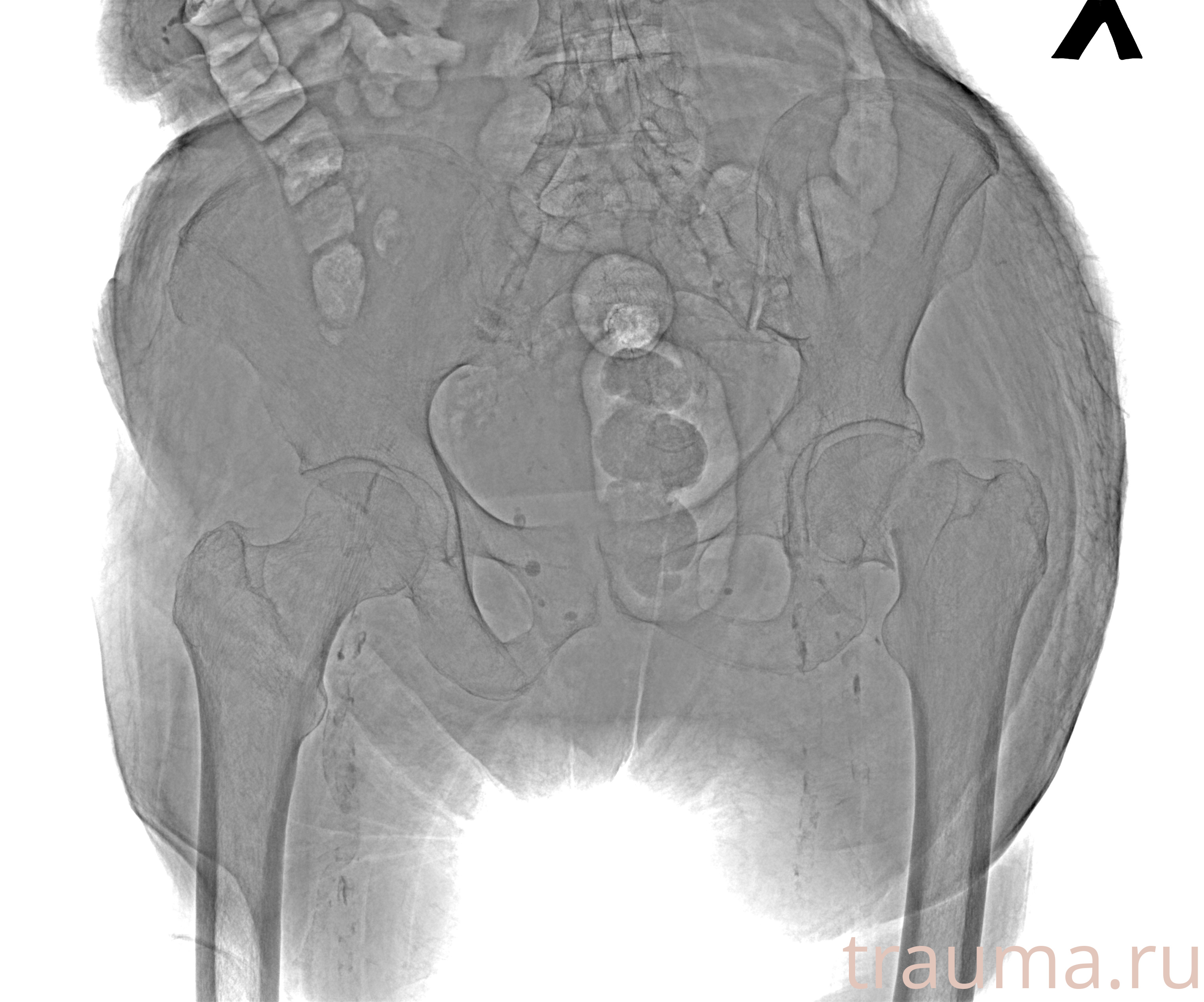 Рентген на дому: по вашему адресу приезжает врач-рентгенолог, травматолог-ортопед с мобильным рентгеновским аппаратом, проводит диагностику травмы или заболевания, делает необходимые рентгенограммы, дает рекомендации по дальнейшему лечению. Получить качественные снимки в домашних условиях возможно благодаря уникальной методике, разработанной МосРентген Центром для института  Склифосовского