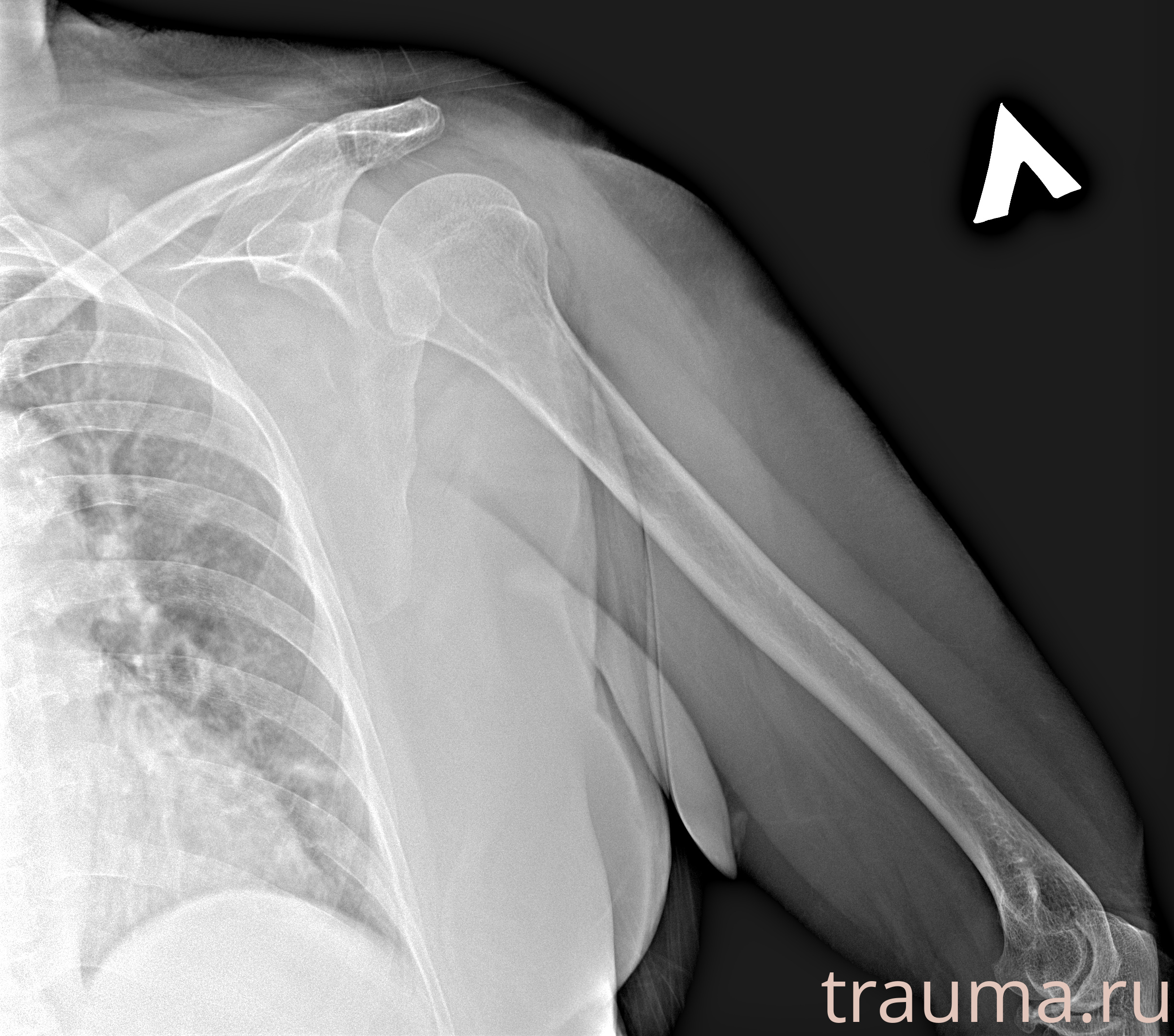 Рентген на дому: по вашему адресу приезжает врач-рентгенолог, травматолог-ортопед с мобильным рентгеновским аппаратом, проводит диагностику травмы или заболевания, делает необходимые рентгенограммы, дает рекомендации по дальнейшему лечению. Получить качественные снимки в домашних условиях возможно благодаря уникальной методике, разработанной МосРентген Центром для института  Склифосовского