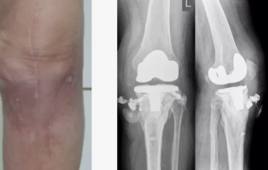 Перспективы применения ацетилсалициловой кислоты в комбинации с антибактериальными препаратами против ведущих возбудителей остеомиелита
