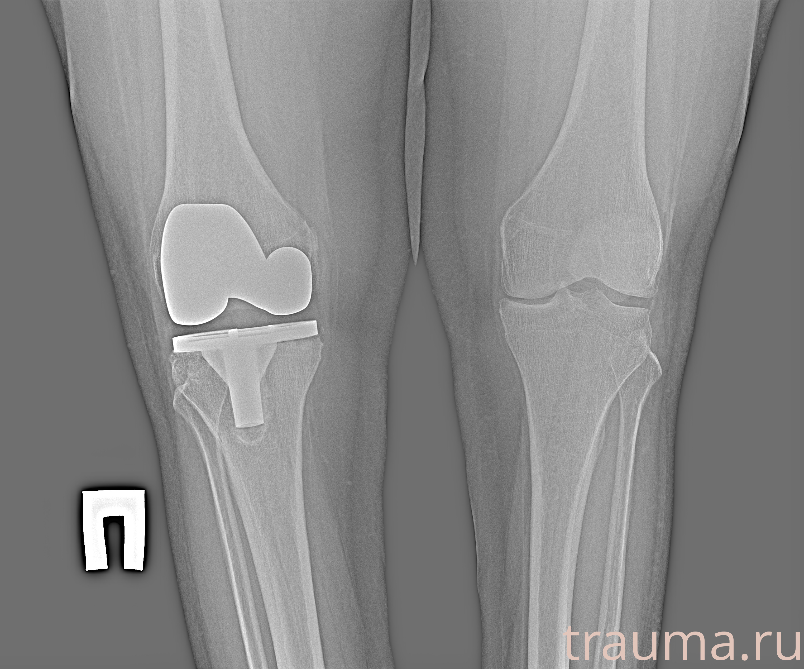 Рентген на дому: по вашему адресу приезжает врач-рентгенолог, травматолог-ортопед с мобильным рентгеновским аппаратом, проводит диагностику травмы или заболевания, делает необходимые рентгенограммы, дает рекомендации по дальнейшему лечению. Получить качественные снимки в домашних условиях возможно благодаря уникальной методике, разработанной МосРентген Центром для института  Склифосовского
