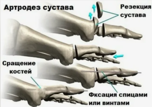 Ревизионные оперативные вмешательства после артродезирования голеностопного сустава с фиксацией ретроградным интрамедуллярным стержнем на фоне осложнений механического происхождения
Ревизионные оперативные вмешательства после артродезирования голеностопного сустава с фиксацией ретроградным интрамедуллярным стержнем на фоне осложнений механического происхождения