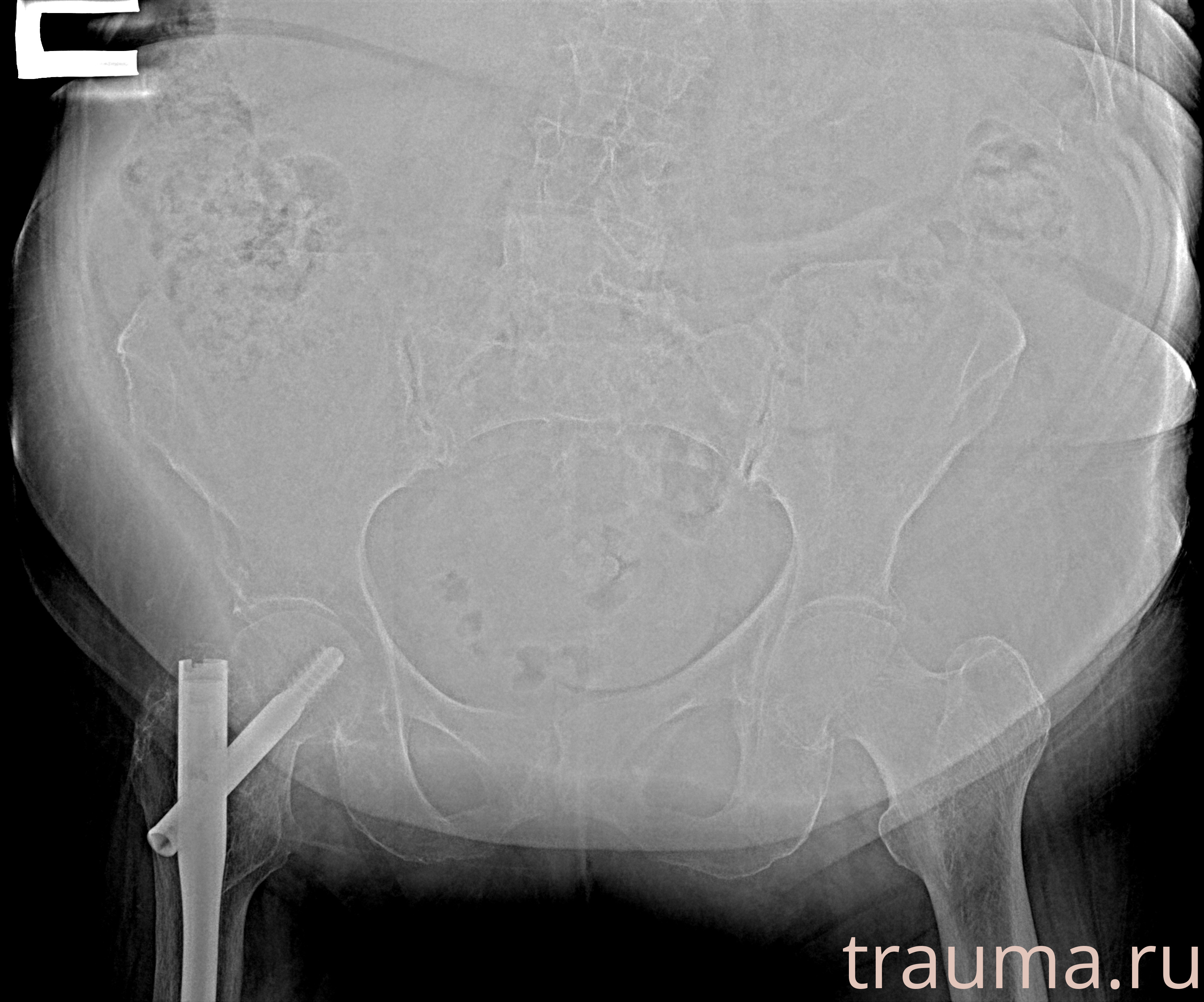 Рентген на дому: по вашему адресу приезжает врач-рентгенолог, травматолог-ортопед с мобильным рентгеновским аппаратом, проводит диагностику травмы или заболевания, делает необходимые рентгенограммы, дает рекомендации по дальнейшему лечению. Получить качественные снимки в домашних условиях возможно благодаря уникальной методике, разработанной МосРентген Центром для института  Склифосовского