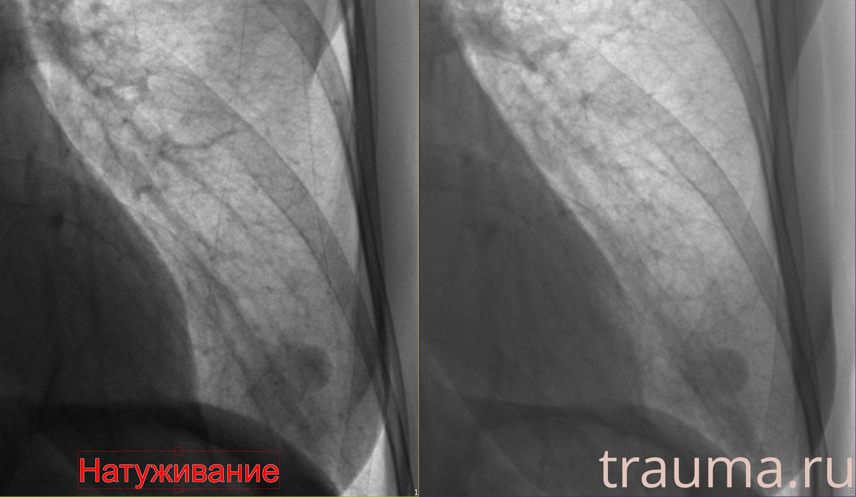 Рентген на дому: по вашему адресу приезжает врач-рентгенолог, травматолог-ортопед с мобильным рентгеновским аппаратом, проводит диагностику травмы или заболевания, делает необходимые рентгенограммы, дает рекомендации по дальнейшему лечению. Получить качественные снимки в домашних условиях возможно благодаря уникальной методике, разработанной МосРентген Центром для института  Склифосовского