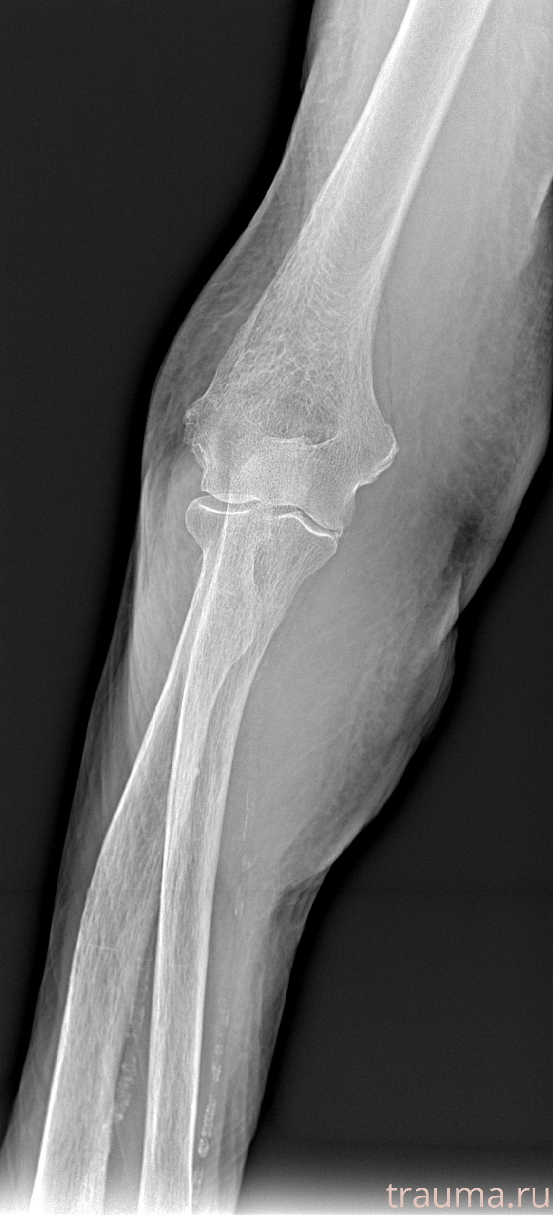 Рентген на дому: по вашему адресу приезжает врач-рентгенолог, травматолог-ортопед с мобильным рентгеновским аппаратом, проводит диагностику травмы или заболевания, делает необходимые рентгенограммы, дает рекомендации по дальнейшему лечению. Получить качественные снимки в домашних условиях возможно благодаря уникальной методике, разработанной МосРентген Центром для института  Склифосовского