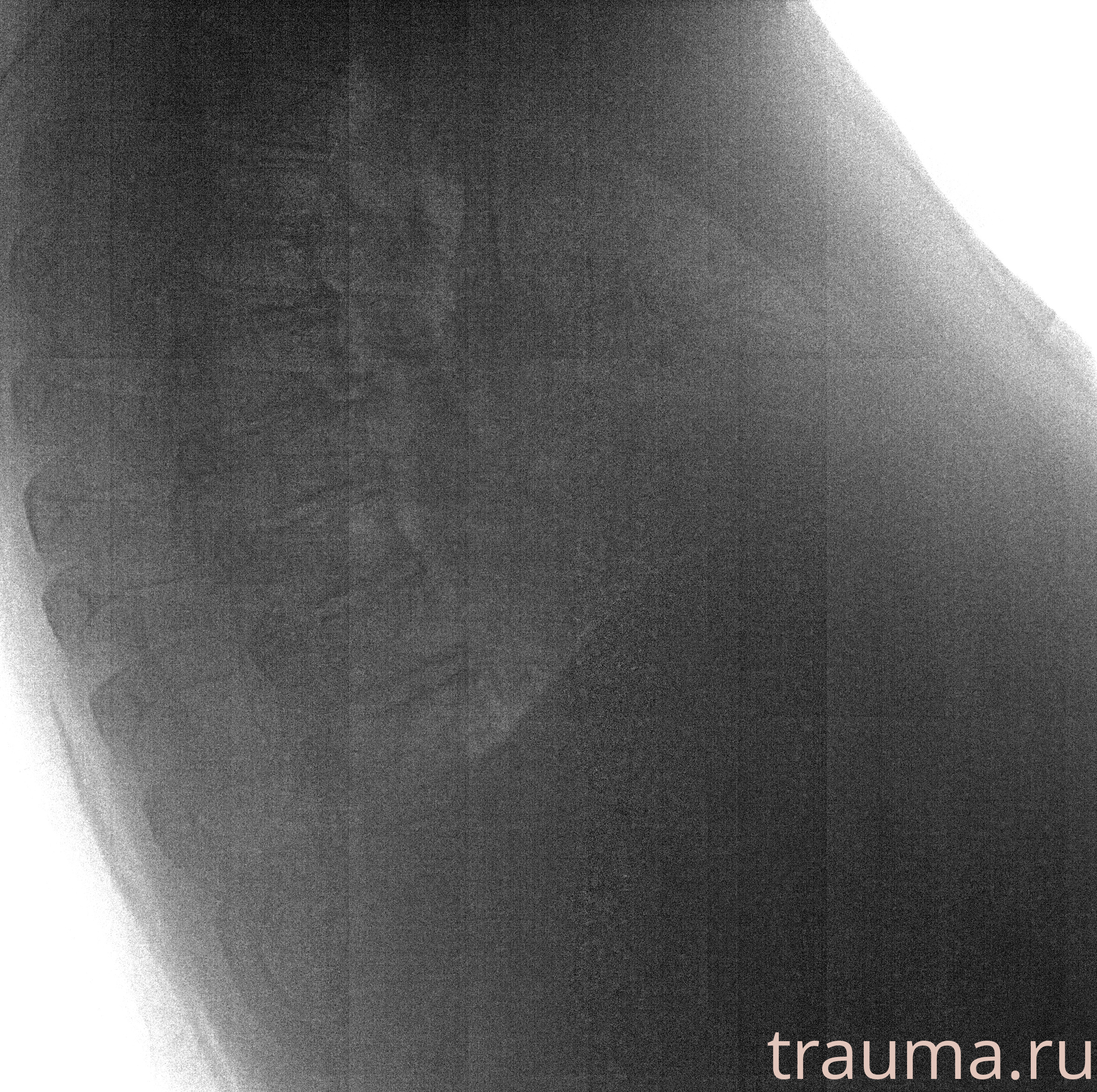 Рентген на дому: по вашему адресу приезжает врач-рентгенолог, травматолог-ортопед с мобильным рентгеновским аппаратом, проводит диагностику травмы или заболевания, делает необходимые рентгенограммы, дает рекомендации по дальнейшему лечению. Получить качественные снимки в домашних условиях возможно благодаря уникальной методике, разработанной МосРентген Центром для института  Склифосовского