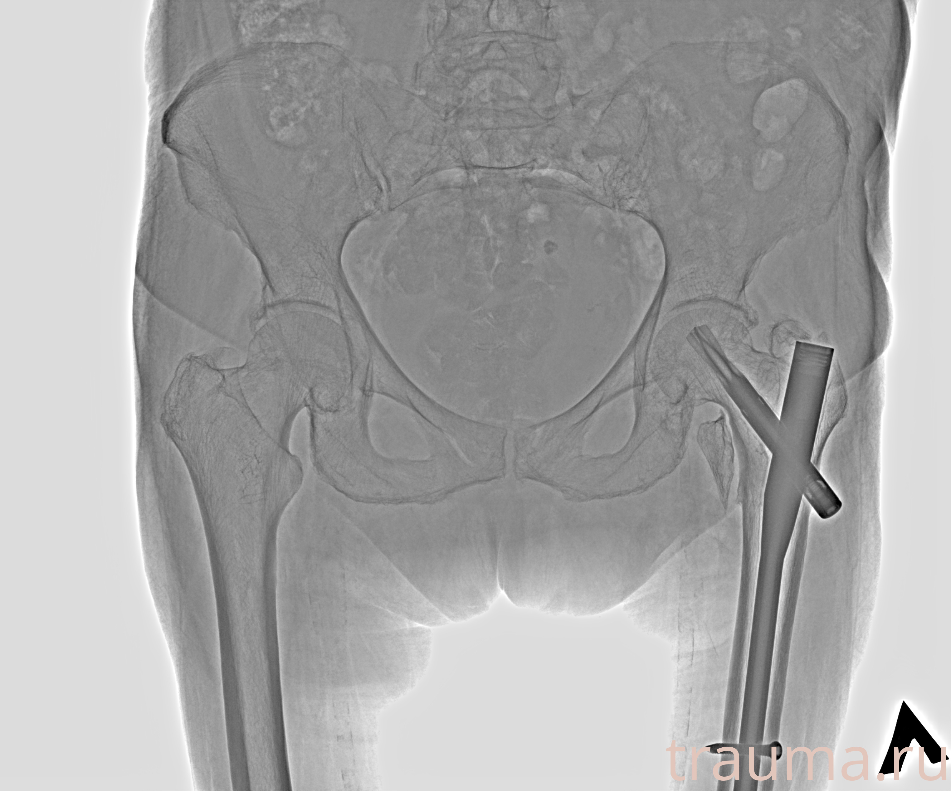 Рентген на дому: по вашему адресу приезжает врач-рентгенолог, травматолог-ортопед с мобильным рентгеновским аппаратом, проводит диагностику травмы или заболевания, делает необходимые рентгенограммы, дает рекомендации по дальнейшему лечению. Получить качественные снимки в домашних условиях возможно благодаря уникальной методике, разработанной МосРентген Центром для института  Склифосовского