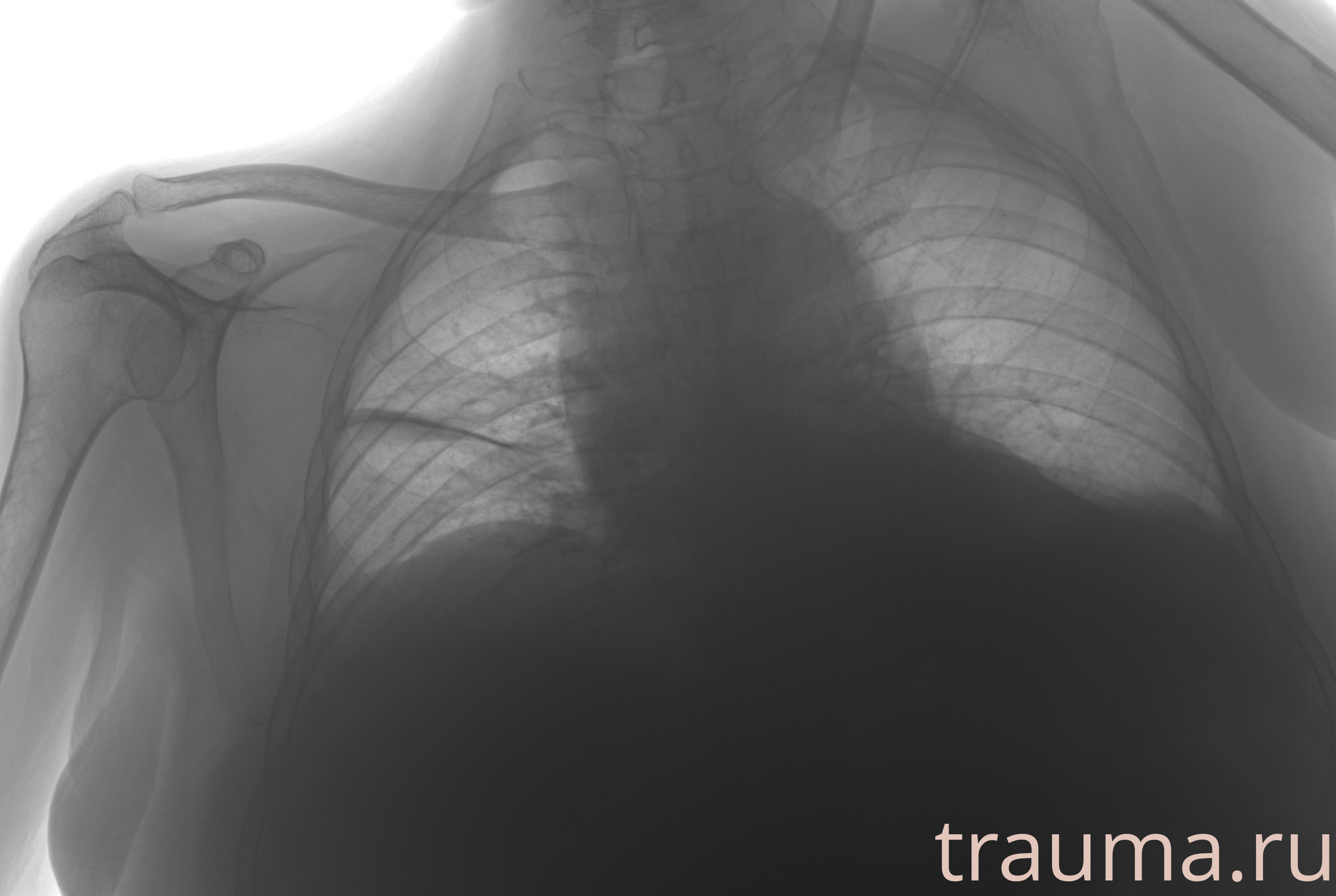 Рентген на дому: по вашему адресу приезжает врач-рентгенолог, травматолог-ортопед с мобильным рентгеновским аппаратом, проводит диагностику травмы или заболевания, делает необходимые рентгенограммы, дает рекомендации по дальнейшему лечению. Получить качественные снимки в домашних условиях возможно благодаря уникальной методике, разработанной МосРентген Центром для института  Склифосовского