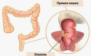 Связь белков экзосом с эффективностью терморадиохимиотерапии у больных c избыточной массой тела и раком прямой кишки: пилотное проспективное когортное исследование
Связь белков экзосом с эффективностью терморадиохимиотерапии у больных c избыточной массой тела и раком прямой кишки: пилотное проспективное когортное исследование