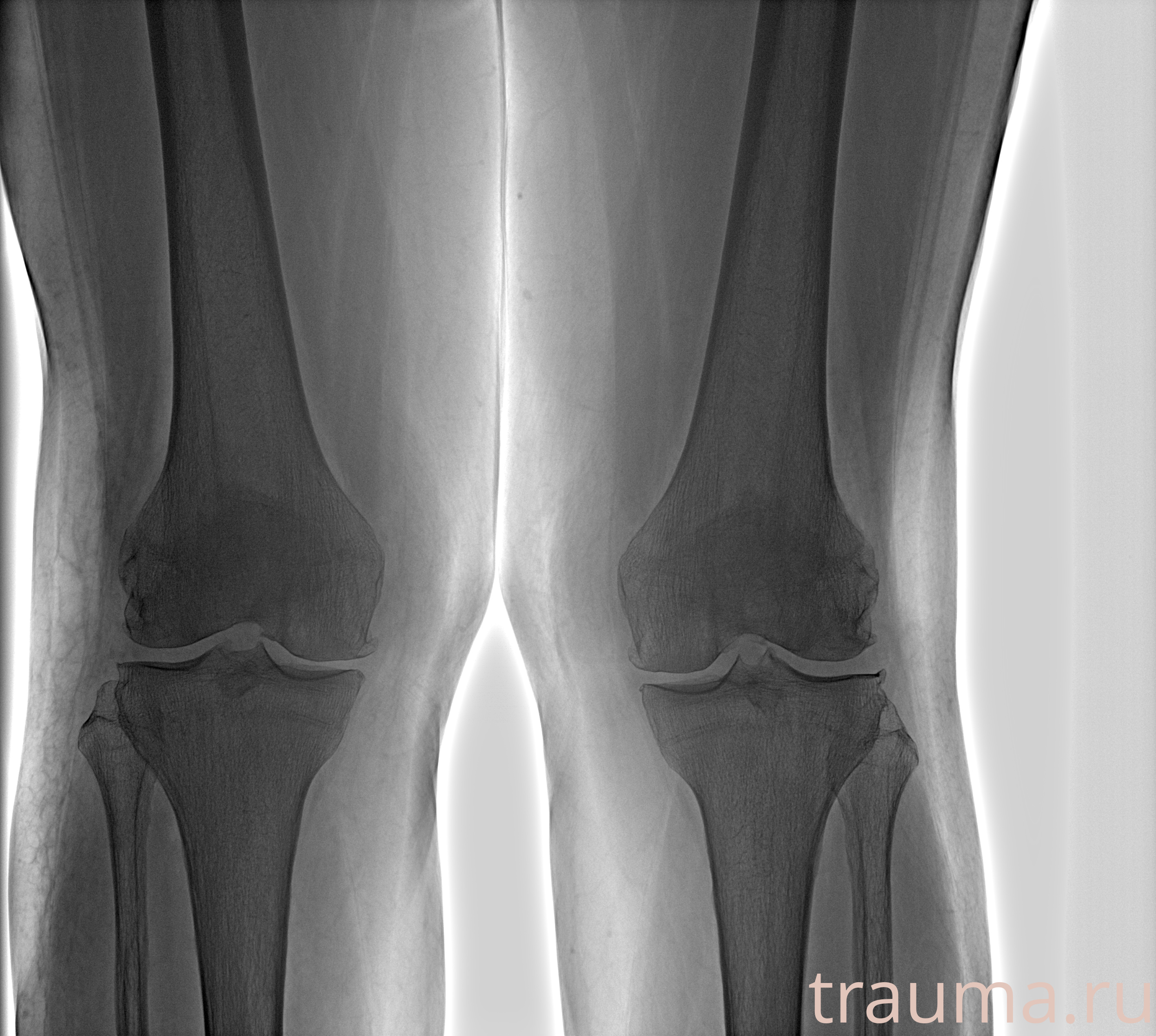 Рентген на дому: по вашему адресу приезжает врач-рентгенолог, травматолог-ортопед с мобильным рентгеновским аппаратом, проводит диагностику травмы или заболевания, делает необходимые рентгенограммы, дает рекомендации по дальнейшему лечению. Получить качественные снимки в домашних условиях возможно благодаря уникальной методике, разработанной МосРентген Центром для института  Склифосовского