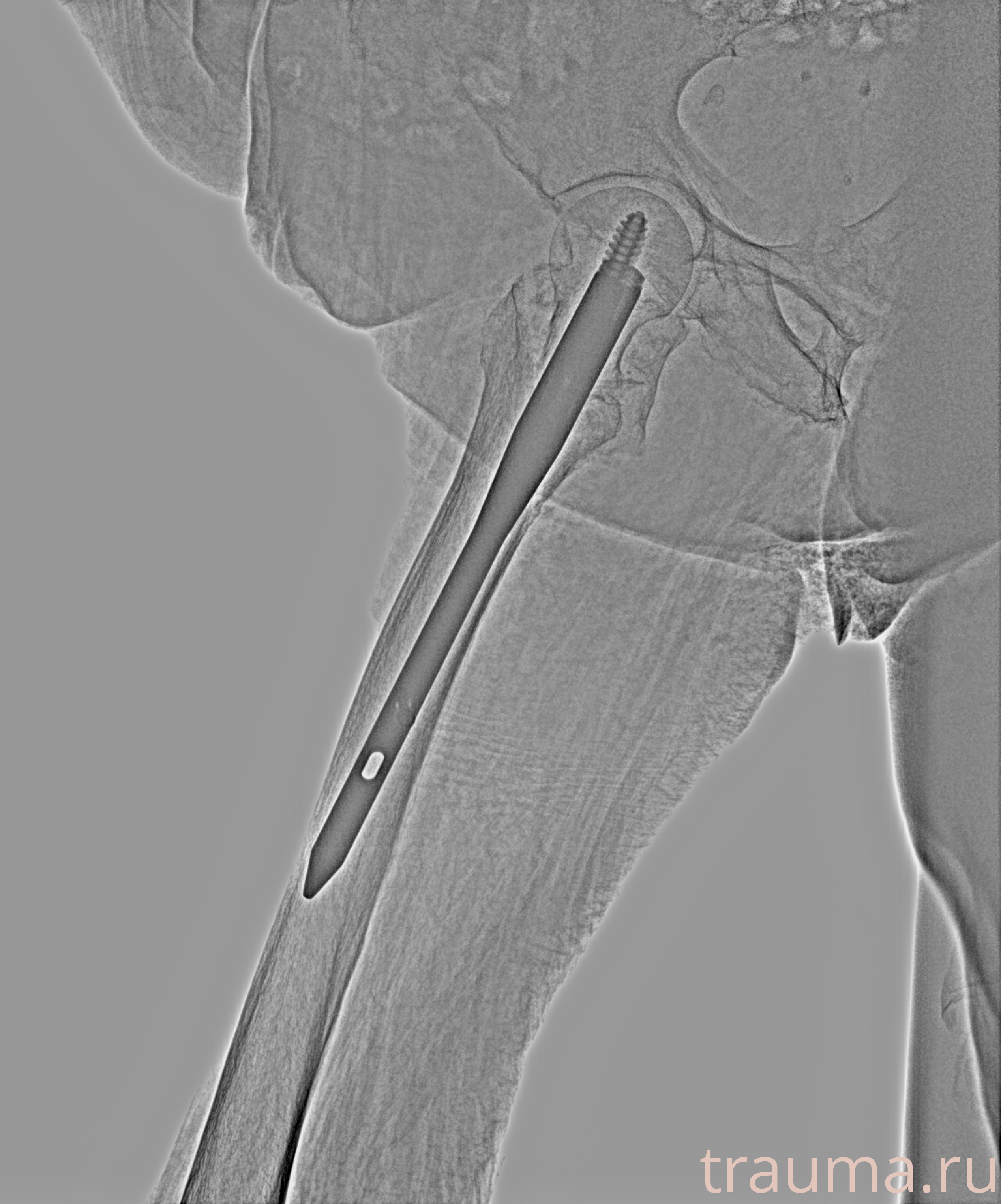 Рентген на дому: по вашему адресу приезжает врач-рентгенолог, травматолог-ортопед с мобильным рентгеновским аппаратом, проводит диагностику травмы или заболевания, делает необходимые рентгенограммы, дает рекомендации по дальнейшему лечению. Получить качественные снимки в домашних условиях возможно благодаря уникальной методике, разработанной МосРентген Центром для института  Склифосовского