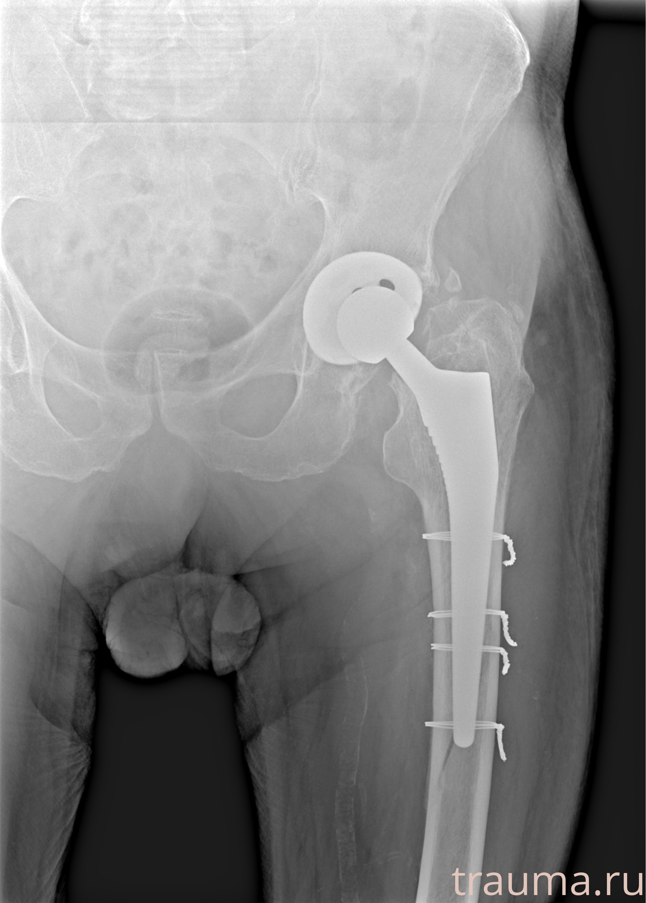 Рентген на дому: по вашему адресу приезжает врач-рентгенолог, травматолог-ортопед с мобильным рентгеновским аппаратом, проводит диагностику травмы или заболевания, делает необходимые рентгенограммы, дает рекомендации по дальнейшему лечению. Получить качественные снимки в домашних условиях возможно благодаря уникальной методике, разработанной МосРентген Центром для института  Склифосовского