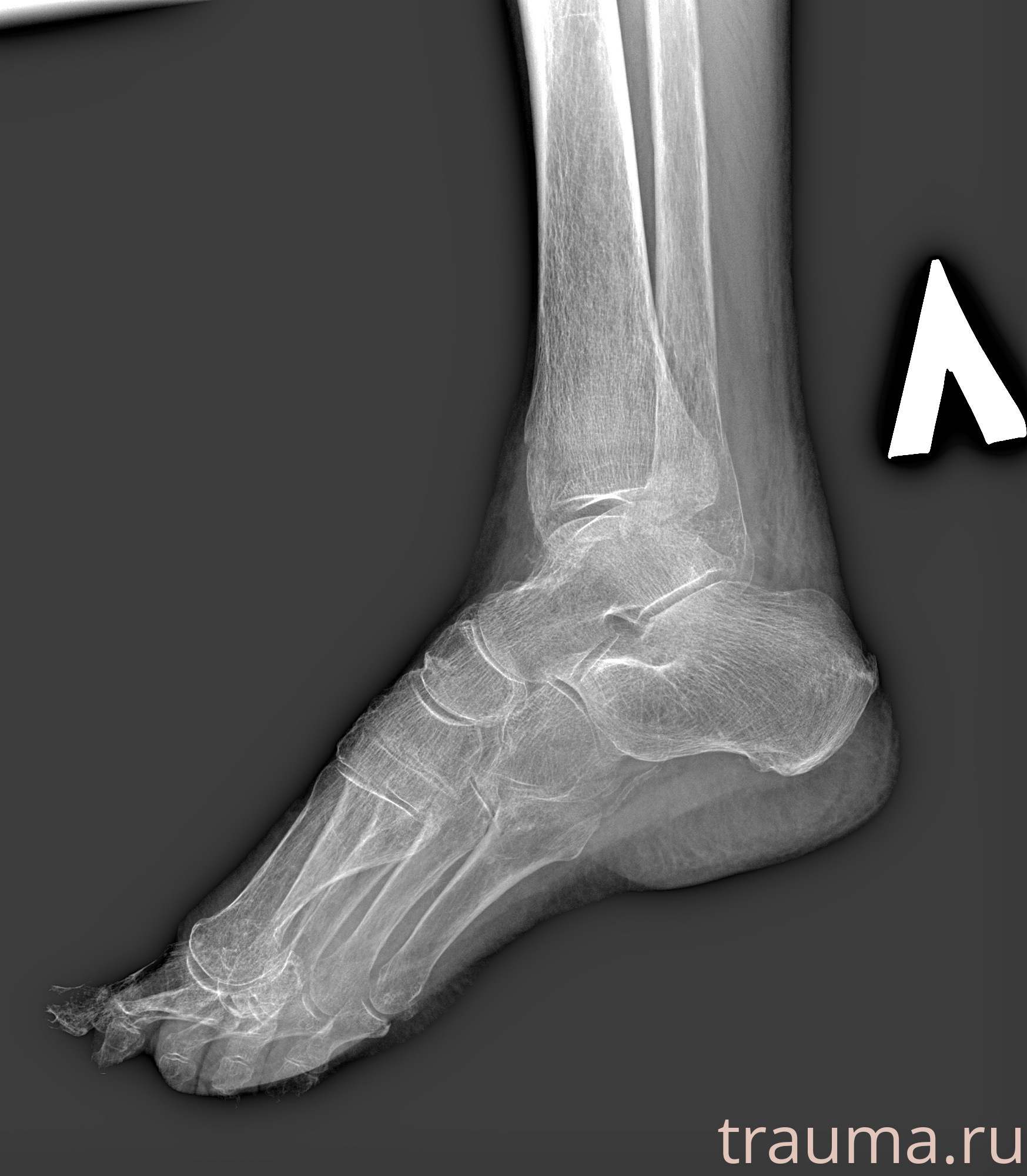 Рентген на дому: по вашему адресу приезжает врач-рентгенолог, травматолог-ортопед с мобильным рентгеновским аппаратом, проводит диагностику травмы или заболевания, делает необходимые рентгенограммы, дает рекомендации по дальнейшему лечению. Получить качественные снимки в домашних условиях возможно благодаря уникальной методике, разработанной МосРентген Центром для института  Склифосовского