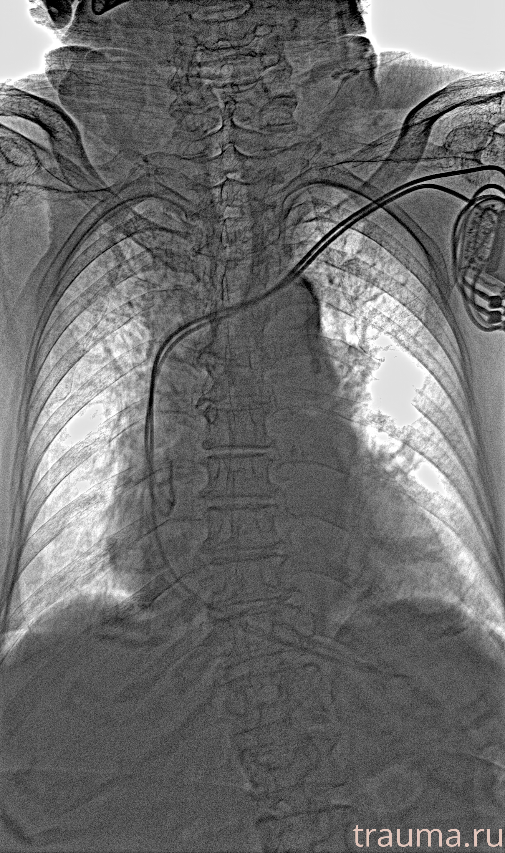 Рентген на дому: по вашему адресу приезжает врач-рентгенолог, травматолог-ортопед с мобильным рентгеновским аппаратом, проводит диагностику травмы или заболевания, делает необходимые рентгенограммы, дает рекомендации по дальнейшему лечению. Получить качественные снимки в домашних условиях возможно благодаря уникальной методике, разработанной МосРентген Центром для института  Склифосовского
