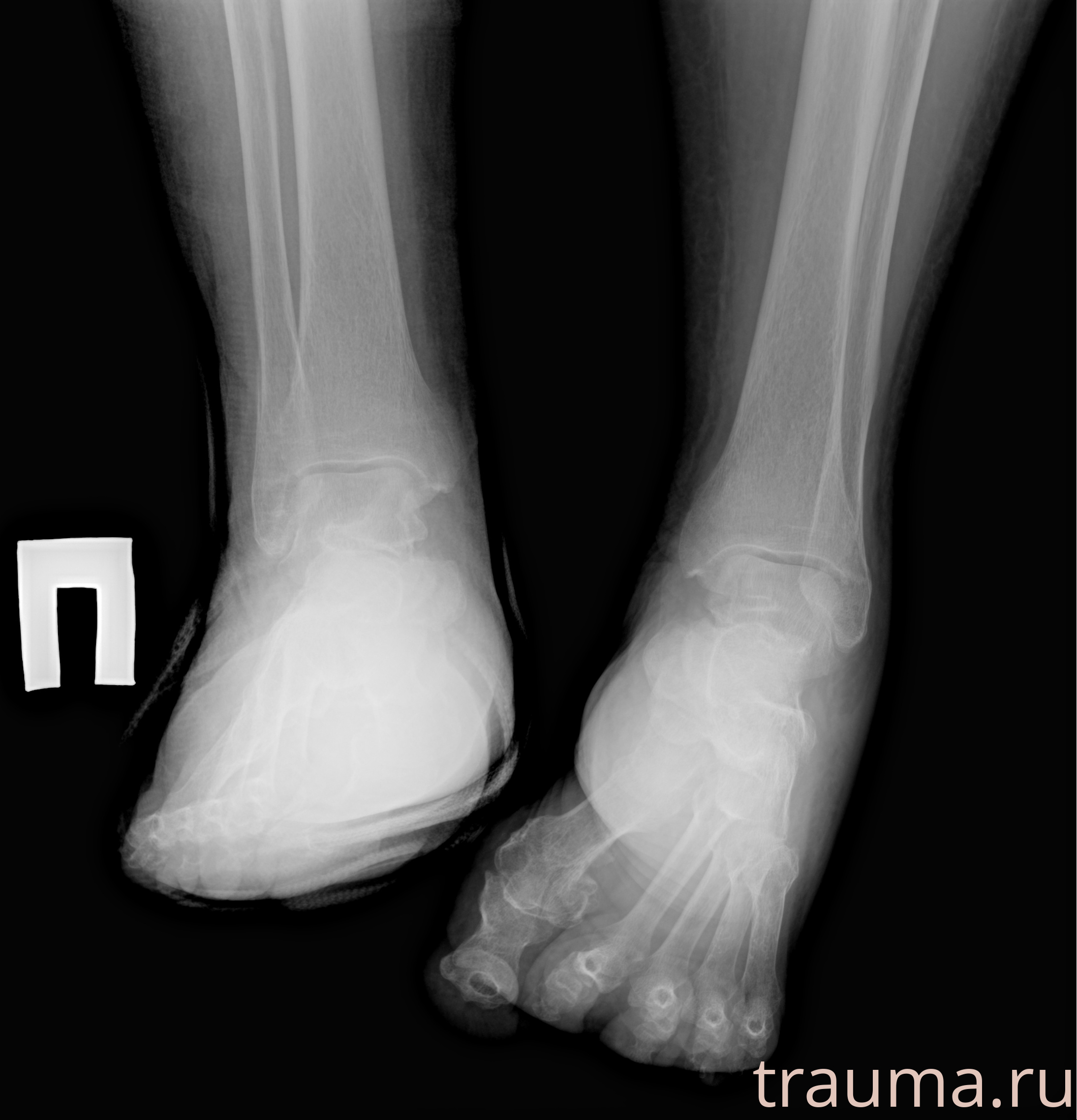 Рентген на дому: по вашему адресу приезжает врач-рентгенолог, травматолог-ортопед с мобильным рентгеновским аппаратом, проводит диагностику травмы или заболевания, делает необходимые рентгенограммы, дает рекомендации по дальнейшему лечению. Получить качественные снимки в домашних условиях возможно благодаря уникальной методике, разработанной МосРентген Центром для института  Склифосовского